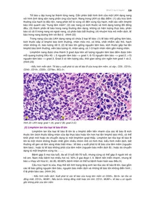 Beänh lyù haïch limphoâ 328
Teá baøo u taäp trung laïi thaønh töøng nang. Caàn phaân bieät hình aûnh cuûa moät LKH daïng nang
vôùi hình aûnh taêng saûn nang phaûn öùng cuûa haïch. Nang trong LKH coù ñaëc ñieåm: (1) caáu truùc bình
thöôøng cuûa haïch bò ñaûo loän, nang phaân boá töø vuøng voû ñeán vuøng tuûy haïch, maát caùc vieàn limphoâ
baøo nhoû quanh caùc “trung taâm maàm”; (2) caùc nang coù kích thöôùc vaø hình daïng töông ñoái ñoàng
ñeàu; (3) thaønh phaàn teá baøo trong nang thöôøng ñôn daïng, khoâng coù hieän töôïng thöïc baøo, phaân
baøo coù caû ôû trong nang vaø ngoaøi nang, coù phaân baøo baát thöôøng; (4) nhuoäm hoùa moâ mieãn dòch, teá
baøo trong nang döông tính vôùi Bcl-2. (Hình 22)
Trong nang cuûa caùc LKH daïng nang coù chöùa 2 loaïi teá baøo: (1) teá baøo nhoû gioáng taâm baøo,
kích thöôùc xaáp xæ limphoâ baøo bình thöôøng, nhaân meùo moù, coù khía, chaát nhieãm saéc thoâ, haïch
nhaân khoâng roõ, baøo töông raát ít; (2) teá baøo lôùn gioáng nguyeân taâm baøo, kích thöôùc gaáp hai laàn
limphoâ baøo bình thöôøng, vieàn baøo töông roõ, nhaân saùng, coù 1-3 haïch nhaân naèm gaàn maøng nhaân.
Limphoâm nang ñöôïc chia thaønh 3 grad döïa treân soá löôïng nguyeân taâm baøo ñeám ñöôïc treân
moãi quang tröôøng VKx 40: ≤ 5 nguyeân taâm baøo --> grad 1; 6-15 nguyeân taâm baøo --> grad 2; >15
nguyeân taâm baøo --> grad 3. Grad 3 coù tieân löôïng xaáu, thôøi gian soáng coøn ngaén hôn grad 1 vaø 2.
(Hình 23)
- Kieåu hình mieãn dòch: Teá baøo u xuaát phaùt töø caùc teá baøo B cuûa trung taâm maàm, coù sIg+, CD5-, CD10+,
CD43-, CD19+, CD20+, CD79a+, BCL-2+.
Hình 23: LKH nang: grad 1 (A); grad 2 (B); grad 3 (C)
(5) Limphoâm lan toûa loaïi teá baøo B lôùn
Limphoâm lan toûa loaïi teá baøo B lôùn laø u limphoâ dieãn tieán nhanh cuûa caùc teá baøo B kích
thöôùc lôùn (kích thöôùc baèng nhaân cuûa ñaïi thöïc baøo hoaëc lôùn hôn hai laàn limphoâ baøo nhoû), coù theå
khôûi phaùt môùi hoaëc do chuyeån daïng töø moät limphoâm grad thaáp. Limphoâm lan toûa loaïi teá baøo B
lôùn laø moät nhoùm khoâng thuaàn nhaát goàm nhieàu nhoùm nhoû coù hình thaùi, kieåu hình mieãn dòch, baát
thöôøng veà gen vaø laâm saøng khaùc bieät nhau : teá baøo u xuaát phaùt töø teá baøo cuûa taâm maàm (nguyeân
taâm baøo) ; hoaëc töø teá baøo khoâng phaûi cuûa taâm maàm (nguyeân baøo mieãn dòch B) ; hoaëc do chuyeån
daïng töø moät limphoâm vuøng rìa ; . . .
Beänh gaëp ôû moïi löùa tuoåi, ña soá ôû tuoåi 60-70 tuoåi, nhöng cuõng coù theå gaëp ôû ngöôøi treû vaø
treû em. Nam maéc beänh hôi nhieàu hôi nöõ. 50% ôû giai ñoaïn I, II. Beänh tieán trieån nhanh, nhöng teá
baøo u nhaïy vôùi hoùa trò ; do ñoù, 60-80% beänh nhaân coù theå lui beänh hoaøn toaøn sau ñieàu trò.
Caáu truùc haïch bò xoùa, thay theá bôûi tình traïng taêng sinh lan toûa caùc teá baøo B lôùn, bao goàm
caùc teá baøo gioáng nguyeân taâm baøo, nguyeân baøo mieãn dòch vaø nhöõng teá baøo lôùn khoâng ñieån hình ;
tæ leä phaân baøo cao. (Hình 24).
- Kieåu hình mieãn dòch: Xuaát phaùt töø caùc teá baøo cuûa trung taâm maàm coù CD20+, Bcl-6+ lan toûa vaø
ñoàng nhaát, CD10+, MUM1-; Neáu bcl-6+ khoâng ñoàng nhaát hoaëc aâm tính, CD10-, MUM1+, teá baøo u coù nguoàn
goác khoâng phaûi cuûa taâm maàm
 