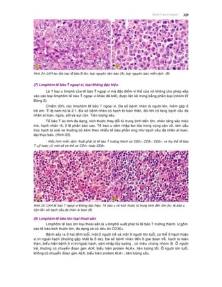 Beänh lyù haïch limphoâ 329
Hình 24: LKH lan toûa loaïi teá baøo B lôùn: loaïi nguyeân taâm baøo (A); loaïi nguyeân baøo mieãn dòch (B)
(7) Limphoâm teá baøo T ngoaïi vi, loaïi khoâng ñaëc hieäu
Laø 1 loaïi u limphoâ cuûa teá baøo T ngoaïi vi maø ñaëc ñieåm vi theå cuûa noù khoâng cho pheùp xeáp
vaøo caùc loaïi limphoâm teá baøo T ngoaïi vi khaùc ñaõ bieát, ñöôïc lieät keâ trong baûng phaân loaïi (nhoùm IV
Baûng 3).
Chieám 30% caùc limphoâm teá baøo T ngoaïi vi. Ña soá beänh nhaân laø ngöôøi lôùn, hieám gaëp ôû
treû em. Tæ leä nam:nöõ laø 2:1. Ña soá beänh nhaân coù haïch to toaøn thaân, ñoâi khi coù taêng baïch caàu ña
nhaân aùi toan, ngöùa, soát vaø suït caân. Tieân löôïng xaáu.
Teá baøo T aùc tính ña daïng, kích thöôùc thay ñoåi töø trung bình ñeán lôùn, nhaân taêng saéc meùo
moù, haïch nhaân roõ, tæ leä phaân baøo cao. Teá baøo u xaâm nhaäp lan toûa trong vuøng caän voû, laøm caáu
truùc haïch bò xoaù vaø thöôøng coù keøm theo nhieàu teá baøo phaûn öùng nhö baïch caàu ña nhaân aùi toan,
ñaïi thöïc baøo. (Hình 25)
- Kieåu hình mieãn dòch: Xuaát phaùt töø teá baøo T tröôøng thaønh coù CD2+, CD3+, CD5+, vaø thuï theå teá baøo
T α hoaëc , moät soá coù theå coù CD4+ hoaëc CD8+.
Hình 25: LKH teá baøo T ngoaïi vi khoâng ñaëc hieäu: Teá baøo u coù kích thöôùc töø trung bình ñeán lôùn (A); teá baøo u
troän laãn vôùi baïch caàu ña nhaân aùi toan (B)
(8) Limphoâm teá baøo lôùn loaïi thoaùi saûn
Limphoâm teá baøo lôùn loaïi thoaùi saûn laø u limphoâ xuaát phaùt töø teá baøo T tröôûng thaønh. U goàm
caùc teá baøo kích thöôùc lôùn, ña daïng vaø coù daáu aán CD30+.
Beänh xaûy ra ôû hai ñænh tuoåi, moät ôû ngöôøi treû vaø moät ôû ngöôøi lôùn tuoåi, coù theå ôû haïch hoaëc
vò trí ngoaøi haïch (thöôøng gaëp nhaát laø ôû da). Ña soá beänh nhaân ñeán ôû giai ñoaïn treã, haïch to toaøn
thaân, bieåu hieän beänh ôû vò trí ngoaøi haïch, xaâm nhaäp tuûy xöông , coù trieäu chöùng nhoùm B. ÔÛ ngöôøi
treû, thöôøng coù chuyeån ñoaïn gen ALK, bieåu hieän protein ALK+, tieân löôïng toát. ÔÛ ngöôøi lôùn tuoåi,
khoâng coù chuyeån ñoaïn gen ALK, bieåu hieän protein ALK- , tieân löôïng xaáu.
 