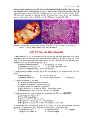 Beänh lyù haïch limphoâ 332
baøo gai, khoái u nguyeân phaùt coù theå ôû ñöôøng hoâ haáp hay tieâu hoaù treân nhö haàu, thanh quaûn. Ung
thö di caên ñeán haïch treân ñoøn ña soá laø töø phoåi hay tuyeán vuù. Neáu laø haïch treân ñoøn traùi, nhieàu khaû
naêng khoái ung thö nguyeân phaùt naèm ôû daï daøy, tuïy, tuyeán tieàn lieät vaø tinh hoaøn. Ung thö di caên
ñeán haïch naùch thöôøng laø töø tuyeán vuù. Ung thö di caên haïch beïn thöôøng laø caùc ung thö cuûa cô
quan sinh duïc ngoaøi, meâlanoâm aùc hoaëc carcinoâm teá baøo gai ôû chi döôùi. (Hình 28)
Hình 28: Carcinoâm teá baøo gai di caên haïch, moät phaàn moâ haïch bò xaâm nhieãm bôûi khoái ung thö di caên (muõi
teân) (A); Teá baøo gai ung thö bieät hoaù roõ taïo nhieàu caàu söøng (B).
MOÄT SOÁ CAÂU HOÛI TÖÏ LÖÔÏNG GIAÙ
1. Beänh nhaân nöõ 52 tuoåi bò noåi nhieàu haïch coå sau moät thôøi gian ñöôïc ñieàu trò vôùi thuoác choáng
ñoäng kinh. Treân maãu sinh thieát haïch thaáy vuøng voû vaø vuøng tuûy bò thu heïp do vuøng caän voû lôùn
roäng, coù raát nhieàu limphoâ baøo nhoû, nhieàu nguyeân baøo mieãn dòch vaø caùc maïch maùu taêng sinh.
Chaån ñoaùn phuø hôïp nhaát trong tröôøng hôïp naøy laø:
A/ Haïch vieâm caáp tính hoaïi töû B/ Haïch taêng saûn xoang
C/ Haïch taêng saûn vuøng caän voû D/ LKH lan toûa loaïi teá baøo B lôùn
E/ Limphoâm Hodgkin loaïi giaøu limphoâ baøo daïng cuïc
2. Trong Limphoâm Hodgkin kinh ñieån, loaïi teá baøo naøo sau ñaây laø tieâu chuaån caàn thieát cho chaån
ñoaùn:
A/ Teá baøo Hodgkin B/ Teá baøo R-S daïng hoác
C/ Teá baøo R-S kinh ñieån D/ Teá baøo R-S daïng thoaùi saûn E/ teá baøo LP
3. Ung thö di caên haïch coù ñaëc ñieåm:
A/ Deã daøng phaân bieät vôùi limphoâm cuûa haïch
B/ Carcinoâm vaø meâlanoâm ít khi cho di caên haïch
C/ Sarcoâm thöôøng cho di caên haïch nhieàu nhaát
D/ Vò trí haïch di caên vaø hình aûnh vi theå gôïi yù khoái u nguyeân phaùt
E/ Teá baøo ung thö thöôøng xaâm nhaäp tröôùc tieân vaøo xoang tuûy
4. Nang limphoâ taêng saûn trong haïch taêng saûn nang coù caùc ñaëc ñieåm sau, NGOAÏI TRÖØ
A/ Kích thöôùc to nhoû khoâng ñeàu
B/ Phaân boá ôû vuøng voû haïch
C/ Coù vieàn limphoâ baøo nhoû bao quanh
D/ Trung taâm maàm ña daïng teá baøo, nhieàu phaân baøo
E/ Trung taâm maàm döông tính vôùi bcl-2 (nhuoäm hoùa moâ mieãn dòch)
5. Trong tröôøng hôïp LKH daïng nang grad 3, teá baøo u taêng sinh aùc tính mang kieåu hình mieãn dòch
gioáng vôùi loaïi teá baøo limphoâ ñang ôû giai ñoaïn bieät hoùa chuyeån daïng naøo sau ñaây?
A/ Limphoâ baøo B nhoû B/ Nguyeân taâm baøo C/ Töông baøo
D/ Nguyeân baøo limphoâ B E/ Teá baøo B vuøng rìa
 