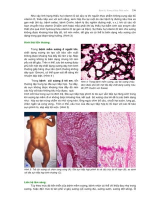 Beänh Lyù Xöông Khôùp Phaàn meàm 336
Nhö vaäy tình traïng thieáu huït vitamin D seõ xaûy ra khi nguoàn thöïc phaåm khoâng cung caáp ñuû
vitamin D, thieáu tieáp xuùc vôùi aùnh naéng, keùm haáp thu taïi ruoät do caùc beänh lyù ñöôøng tieâu hoùa vaø
gan maät (thí duï: beänh celiac, beänh Crohn, beänh lyù taéc ngheõn ñöôøng maät, v.v.), khi coù caùc roái
loaïn chuyeån hoùa vitamin D baåm sinh hoaëc maéc phaûi (thí duï thieáu huït baåm sinh caùc enzym caàn
thieát cho quaù trình hydroxyl hoùa vitamin D taïi gan vaø thaän). Söï thieáu huït vitamin D laøm cho xöông
khoâng ñöôïc khoaùng hoùa ñaày ñuû, trôû neân meàm, deã gaõy vaø coù theå bò bieán daïng neáu xöông coøn
ñang trong giai ñoaïn taêng tröôûng. (Hinh 3)
Hình thaùi toån thöông:
Trong beänh meàm xöông ôû ngöôøi lôùn,
chaát daïng xöông do taïo coát baøo saûn xuaát
khoâng ñöôïc khoaùng hoùa ñaày ñuû neân öù laïi. Maëc
duø xöông khoâng bò bieán daïng nhöng trôû neân
yeáu vaø deã gaõy. Treân vi theå, caùc beø xöông ñöôïc
phuû bôûi moät lôùp chaát daïng xöông daøy hôn bình
thöôøng gaáp haøng chuïc laàn (bình thöôøng khoâng
daøy quaù 12mcm), coù theå quan saùt deã daøng khi
nhuoäm ñaëc bieät. (Hình 4 )
Trong beänh coøi xöông ôû treû em, toån
thöông taäp trung taïi ñóa suïn tieáp hôïp. Taïi ñaây,
do suïn khoâng ñöôïc khoaùng hoùa ñaày ñuû neân
caùc huûy coát baøo khoâng tieâu huûy ñöôïc; quaù
Hình 4: Trong beänh meàm xöông, caùc beø xöông (maøu
ñen) ñöôïc phuû bôûi moät lôùp daày chaát daïng xöông maøu
ñoû (PP nhuoäm von Kassa)
trình coát hoùa trong suïn bò ñình treä. Ñóa suïn tieáp hôïp phình to do suïn vaãn tieáp tuïc taêng sinh trong
khi xöông laïi meàm ñi vì khoâng ñöôïc khoaùng hoùa, keát quaû boä xöông cuûa treû deã bò caùc bieán daïng
nhö: hoäp soï deït vuøng chaåm vaø nhoâ vuøng traùn, loàng ngöïc chim boà caâu, chuoãi haït söôøn, löng guø,
chaân ngaén vaø cong voøng… Treân vi theå, caáu truùc cuûa ñóa suïn tieáp hôïp bò roái loaïn vôùi caùc teá baøo
suïn phình to, saép xeáp loän xoän. (Hình 5)
Hình 5: Treû coøi xöông coù chaân cong voøng (A); Ñóa suïn tieáp hôïp phình to vaø caáu truùc bò roái loaïn (B), so saùnh
vôùi ñóa suïn tieáp hôïp bình thöôøng (C).
Lieân heä laâm saøng:
Tuøy theo möùc ñoä tieán trieån cuûa beänh meàm xöông, beänh nhaân coù theå chæ thaáy ñau nheï trong
xöông, hoaëc ñeán möùc bò taøn pheá vì gaõy xöông (coå xöông ñuøi, xöông söôøn, xöông ñoát soáng). ÔÛ
 