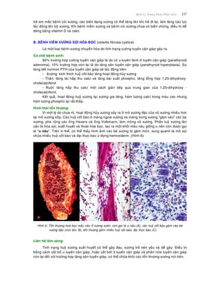 Beänh Lyù Xöông Khôùp Phaàn meàm 337
treû em maéc beänh coøi xöông, caùc bieán daïng xöông coù theå taêng leân khi treû ñi laïi, laøm taêng caùc löïc
taùc ñoäng leân boä xöông. Khi beänh meàm xöông vaø beänh coøi xöông chöa coù bieán chöùng, ñieàu trò deã
daøng baèng vitamin D vaø calci.
B. BEÄNH VIEÂM XÖÔNG SÔÏI HOÙA BOÏC (osteitis fibrosa cystica)
Laø moät loaïi beänh xöông chuyeån hoùa do tình traïng cöôøng tuyeán caän giaùp gaây ra.
Cô cheá beänh sinh:
90% tröôøng hôïp cöôøng tuyeán caän giaùp laø do coù u tuyeán laønh ôû tuyeán caän giaùp (parathyroid
adenoma), 10% tröôøng hôïp coøn laïi laø do taêng saûn tuyeán caän giaùp (parathyroid hyperplasia). Söï
taêng tieát hormon PTH cuûa tuyeán caän giaùp seõ taùc ñoäng treân:
- Xöông: kích thích huyû coát baøo taêng hoaït ñoäng huûy xöông
- Thaän: taêng taùi haáp thu calci vaø taêng baøi xuaát phospho, taêng toång hôïp 1,25-dihydroxy-
cholecalciferol
- Ruoät: taêng haáp thu calci moät caùch giaùn tieáp qua trung gian cuûa 1,25-dihydroxy -
cholecalciferol.
Keát quaû, hoaït ñoäng huyû xöông taïi xöông gia taêng, haøm löôïng calci trong maùu cao nhöng
haøm löôïng phospho laïi raát thaáp.
Hình thaùi toån thöông:
Vì moät lyù do chöa roõ, hoaït ñoäng huûy xöông xaûy ra ôû moâ xöông ñaëc cuûa voû xöông nhieàu hôn
taïi moâ xöông xoáp. Caùc huyû coát baøo ôû maøng ngoaøi xöông vaø maøng trong xöông “gaëm vaøo” caùc beø
xöông, phaù roäng caùc oáng Havers vaø oáng Volkmann, laøm moûng voû xöông. Phaàn tuyû xöông laân
caän bò hoùa sôïi, xuaát huyeát vaø thoaùi hoaù boïc, taïo ra moät khoái maàu naâu gioáng u neân coøn ñöôïc goïi
laø “u naâu”. Treân vi theå, coù theå thaáy hình aûnh caùc beø xöông bò gaëm moøn, xung quanh laø moâ sôïi
chöùa nhieàu huyû coát baøo vaø ñaïi thöïc baøo öù ñoïng hemosiderin. (Hình 6)
Hinh 6: Toån thöông hoaù boïc maàu naâu ôû xöông söôøn, coøn goïi laø u naâu (A), caùc huyû coát baøo gaëm vaøo beø
xöông ñaëc (muõi teân, B), toån thöông goàm nhieàu huyû coát baøo, ñaïi thöïc baøo (C).
Lieân heä laâm saøng:
Tình traïng huyû xöông xuaát huyeát coù theå gaây ñau, xöông trôû neân yeáu vaø deã gaõy. Ñieàu trò
baèng caùch caét boû u tuyeán caän giaùp, hoaëc caét bôùt 3 tuyeán caän giaùp vaø phaân nöûa tuyeán caän giaùp
coøn laïi ñoái vôùi tröôøng hôïp taêng saûn tuyeán giaùp, coù theå chöõa khoûi caùc toån thöông xöông noùi treân.
 
