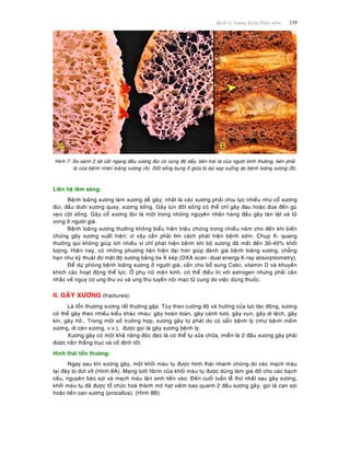 Beänh Lyù Xöông Khôùp Phaàn meàm 339
Hình 7: So saùnh 2 laùt caét ngang ñaàu xöông ñuøi coù cuøng ñoä daày, beân traùi laø cuûa ngöôøi bình thöôøng, beân phaûi
laø cuûa beänh nhaân loaõng xöông (A). Ñoát soáng buïng ôû giöõa bò eùp xeïp xuoáng do beänh loaõng xöông (B).
Lieân heä laâm saøng:
Beänh loaõng xöông laøm xöông deã gaõy; nhaát laø caùc xöông phaûi chòu löïc nhieàu nhö coå xöông
ñuøi, ñaàu döôùi xöông quay, xöông soáng. Gaõy luùn ñoát soáng coù theå chæ gaây ñau hoaëc ñöa ñeán guø
veïo coät soáng. Gaõy coå xöông ñuøi laø moät trong nhöõng nguyeân nhaân haøng ñaàu gaây taøn taät vaø töû
vong ôû ngöôøi giaø.
Beänh loaõng xöông thöôøng khoâng bieåu hieän trieäu chöùng trong nhieàu naêm cho ñeán khi bieán
chöùng gaõy xöông xuaát hieän; vì vaäy caàn phaûi tìm caùch phaùt hieän beänh sôùm. Chuïp X- quang
thöôøng qui khoâng giuùp ích nhieàu vì chæ phaùt hieän beänh khi boä xöông ñaõ maát ñeán 30-40% khoái
löôïng. Hieän nay, coù nhöõng phöông tieän hieän ñaïi hôn giuùp ñaùnh giaù beänh loaõng xöông, chaúng
haïn nhö kyõ thuaät ño maät ñoä xöông baèng tia X keùp (DXA scan-dual energyX-ray absorptiometry).
Ñeå döï phoøng beänh loaõng xöông ôû ngöôøi giaø, caàn cho boå sung Calci, vitamin D vaø khuyeán
khích caùc hoaït ñoäng theå löïc. ÔÛ phuï nöõ maõn kinh, coù theå ñieàu trò vôùi estrogen nhöng phaûi caân
nhaéc veà nguy cô ung thö vuù vaø ung thö tuyeán noäi maïc töû cung do vieäc duøng thuoác.
II. GAÕY XÖÔNG (fractures):
Laø toån thöông xöông raát thöôøng gaëp. Tuøy theo cöôøng ñoä vaø höôùng cuûa löïc taùc ñoäng, xöông
coù theå gaõy theo nhieàu kieåu khaùc nhau: gaõy hoaøn toaøn, gaõy caønh töôi, gaõy vuïn, gaõy di leäch, gaõy
kín, gaõy hôû… Trong moät soá tröôøng hôïp, xöông gaõy töï phaùt do coù saün beänh lyù (nhö beänh meàm
xöông, di caên xöông, v.v.), ñöôïc goïi laø gaõy xöông beänh lyù.
Xöông gaõy coù moät khaû naêng ñoäc ñaùo laø coù theå töï söûa chöõa, mieãn laø 2 ñaàu xöông gaõy phaûi
ñöôïc naén thaúng truïc vaø coá ñònh toát.
Hình thaùi toån thöông:
Ngay sau khi xöông gaõy, moät khoái maùu tuï ñöôïc hình thaùi nhanh choùng do caùc maïch maùu
taïi ñaây bò ñöùt vôõ (Hình 8A). Maïng löôùi fibrin cuûa khoái maùu tuï ñöôïc duøng laøm giaù ñôõ cho caùc baïch
caàu, nguyeân baøo sôïi vaø maïch maùu taân sinh tieán vaøo. Ñeán cuoái tuaàn leã thöù nhaát sau gaõy xöông,
khoái maùu tuï ñaõ ñöôïc toå chöùc hoaù thaønh moâ haït vieâm bao quanh 2 ñaàu xöông gaõy, goïi laø can sôïi
hoaëc tieàn can xöông (procallus). (Hình 8B)
 