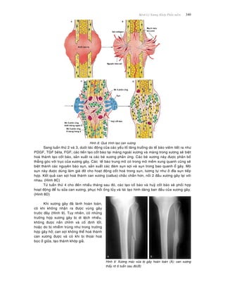 Beänh Lyù Xöông Khôùp Phaàn meàm 340
Hình 8: Quaù trình taïo can xöông
Sang tuaàn thöù 2 vaø 3, döôùi taùc ñoäng cuûa caùc yeáu toá taêng tröôûng do teá baøo vieâm tieát ra nhö
PDGF, TGF beâta, FGF; caùc tieàn taïo coát baøo taïi maøng ngoaøi xöông vaø maøng trong xöông seõ bieät
hoaù thaønh taïo coát baøo, saûn xuaát ra caùc beø xöông phaûn öùng. Caùc beø xöông naøy ñöôïc phaân boá
thaúng goùc vôùi truïc cuûa xöông gaõy. Caùc teá baøo trung moâ coù trong moâ meàm xung quanh cuõng seõ
bieät thaønh caùc nguyeân baøo suïn, saûn xuaát caùc ñaùm suïn sôïi vaø suïn trong bao quanh oå gaõy. Moâ
suïn naøy ñöôïc duøng laøm giaù ñôõ cho hoaït ñoäng coát hoaù trong suïn, töông töï nhö ôû ñóa suïn tieáp
hôïp. Keát quaû can sôïi hoaù thaønh can xöông (callus) chaéc chaén hôn, noái 2 ñaàu xöông gaõy laïi vôùi
nhau. (Hình 8C)
Töø tuaàn thöù 4 cho ñeán nhieàu thaùng sau ñoù, caùc taïo coá baøo vaø huyû coát baøo seõ phoái hôïp
hoaït ñoäng ñeå tu söûa can xöông, phuïc hoài oáng tuûy vaø taùi taïo hình daùng ban ñaàu cuûa xöông gaõy.
(Hình 8D)
Khi xöông gaõy ñaõ laønh hoaøn toaøn,
coù khi khoâng nhaän ra ñöôïc vuøng gaõy
tröôùc ñaây (Hình 9). Tuy nhieân, coù nhöõng
tröôøng hôïp xöông gaõy bò di leäch nhieàu,
khoâng ñöôïc naén chænh vaø coá ñònh toát,
hoaëc do bò nhieãm truøng nhö trong tröôøng
hôïp gaõy hôû; can sôïi khoâng theå hoaù thaønh
can xöông ñöôïc vaø coù khi bò thoaùi hoaù
boïc ôû giöõa, taïo thaønh khôùp giaû.
Hình 9: Xöông maùc vöøa bò gaõy hoaøn toaøn (A); can xöông
thaáy roõ 6 tuaàn sau ñoù(B)
 
