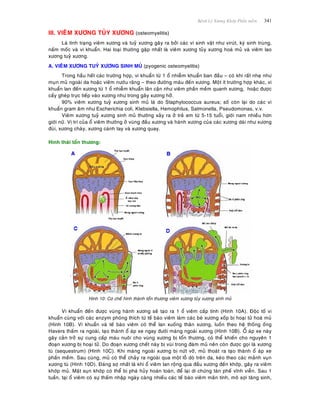 Beänh Lyù Xöông Khôùp Phaàn meàm 341
III. VIEÂM XÖÔNG TUÛY XÖÔNG (osteomyelitis)
Laø tình traïng vieâm xöông vaø tuyû xöông gaây ra bôûi caùc vi sinh vaät nhö viruùt, kyù sinh truøng,
naám moác vaø vi khuaån. Hai loaïi thöôøng gaëp nhaát laø vieâm xöông tuûy xöông hoaù muû vaø vieâm lao
xöông tuyû xöông.
A. VIEÂM XÖÔNG TUYÛ XÖÔNG SINH MUÛ (pyogenic osteomyelitis)
Trong haàu heát caùc tröôøng hôïp, vi khuaån töø 1 oå nhieãm khuaån ban ñaàu – coù khi raát nheï nhö
muïn muû ngoaøi da hoaëc vieâm nöôùu raêng – theo ñöôøng maùu ñeán xöông. Moät ít tröôøng hôïp khaùc, vi
khuaån lan ñeán xöông töø 1 oå nhieãm khuaån laân caän nhö vieâm phaàn meàm quanh xöông, hoaëc ñöôïc
caáy gheùp tröïc tieáp vaøo xöông nhö trong gaõy xöông hôû.
90% vieâm xöông tuyû xöông sinh muû laø do Staphylococcus aureus; soá coøn laïi do caùc vi
khuaån gram aâm nhö Escherichia coli, Klebsiella, Hemophilus, Salmonella, Pseudomonas, v.v.
Vieâm xöông tuyû xöông sinh muû thöôøng xaûy ra ôû treû em töø 5-15 tuoåi, giôùi nam nhieàu hôn
giôùi nöõ. Vò trí cuûa oå vieâm thöôøng ôû vuøng ñaàu xöông vaø haønh xöông cuûa caùc xöông daøi nhö xöông
ñuøi, xöông chaøy, xöông caùnh tay vaø xöông quay.
Hình thaùi toån thöông:
Hình 10: Cô cheá hình thaønh toån thöông vieâm xöông tuûy xöông sinh muû
Vi khuaån ñeán ñöôïc vuøng haønh xöông seõ taïo ra 1 oå vieâm caáp tính (Hình 10A). Ñoäc toá vi
khuaån cuøng vôùi caùc enzym phoùng thích töø teá baøo vieâm laøm caùc beø xöông xoáp bò hoaïi töû hoaù muû
(Hình 10B). Vi khuaån vaø teá baøo vieâm coù theå lan xuoáng thaân xöông, luoàn theo heä thoáng oáng
Havers thaám ra ngoaøi, taïo thaønh oå aùp xe ngay ñöôùi maøng ngoaøi xöông (Hình 10B). OÅ aùp xe naøy
gaây caûn trôû söï cung caáp maùu nuoâi cho vuøng xöông bò toån thöông, coù theå khieán cho nguyeân 1
ñoaïn xöông bò hoaïi töû. Do ñoaïn xöông cheát naøy bò vuøi trong ñaùm muû neân coøn ñöôïc goïi laø xöông
tuø (sequestrum) (Hình 10C). Khi maøng ngoaøi xöông bò nöùt vôõ, muû thoaùt ra taïo thaønh oå aùp xe
phaàn meàm. Sau cuøng, muû coù theå chaûy ra ngoaøi qua moät loã doø treân da, keùo theo caùc maûnh vuïn
xöông tuø (Hình 10D). Ñaùng sôï nhaát laø khi oå vieâm lan roäng qua ñaàu xöông ñeán khôùp, gaây ra vieâm
khôùp muû. Maët suïn khôùp coù theå bò phaù huûy hoaøn toaøn, ñeå laïi di chöùng taøn pheá vónh vieãn. Sau 1
tuaàn, taïi oå vieâm coù söï thaám nhaäp ngaøy caøng nhieàu caùc teá baøo vieâm maõn tính, moâ sôïi taêng sinh,
 