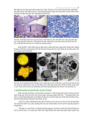 Toån Thöông Cô Baûn cuûa Teá baøo vaø Moâ 27
ñaäm ñaëc do caùc baøo quan beân trong bò leøn chaët. Teá baøo töï huûy cuoái cuøng seõ ñuôïc caét thaønh
caùc theå töï huûy; moãi theå töï huûy laø 1 tuùi maøng chöùa baøo töông, caùc baøo quan vaø caùc maûnh nhaân,
seõ ñöôïc caùc ñaïi thöïc baøo “aên” ngay laäp töùc (Hình 25).
Hình 25: Teá baøo bieåu moâ ruoät töï huyû (muõi teân) coù kích thöôùc thu nhoû, nhaân ñaäm maàu, baøo töông ñaäm ñaëc
(A); Trong trung taâm maàm cuûa 1 nang limphoâ thöù caáp, limphoâ baøo töï huûy phaân thaønh caùc theå töï huûy (muõi
teân) vaø ñaõ ñöôïc ñaïi thöïc baøo “aên” vaø ñöa vaøo trong baøo töông.
Döôùi KHVÑT, chaát nhieãm saéc coâ ñaëc thaønh nhieàu khoái baùm ngay döôùi maøng nhaân. Maøng
teá baøo coù theå taïo ra caùc boùng nhoû treân beà maët nhöng caáu truùc cuûa maøng vaø caùc baøo quan vaãn
coøn nguyeân veïn (Hình 26).
Hình 26: So vôùi limphoâ baøo bình thöôøng ôû treân, limphoâ baøo töï huyû ôû döôùi taïo ra caùc boùng nhoû treân beà maët
(A). Nhaân caùc limphoâ baøo töï huûy coù chaát nhieãm saéc coâ ñaëc döôùi maøng nhaân, ñaõ taùch ra thaønh nhieàu maûnh
(*) (B). Theå töï huyû (muõi teân) cuûa limphoâ baøo cheát naèm trong khoâng baøo tieâu hoaù cuûa 1 ñaïi thöïc baøo (C).
2. NGUYEÂN NHAÂN VAØ CÔ CHEÁ GAÂY TÖÏ HUÛY TEÁ BAØO
Khaùc vôùi hoaïi töû teá baøo, töï huûy teá baøo chuû yeáu laø 1 hieän töôïng sinh lyù bình thöôøng, raát caàn
thieát trong quaù trình taïo hình caùc moâ-cô quan trong giai ñoaïn phoâi thai. Trong giai ñoaïn sau
sinh, töï huyû teá baøo ñaûm baûo söï oån ñònh veà caáu truùc vaø chöùc naêng cuûa nhieàu loaïi moâ khaùc nhau,
loaïi boû nhöõng teá baøo khoâng coøn caàn thieát ; thí duï:
- Caáu truùc tuyeán Lieberkühn ñöôïc ñoåi môùi lieân tuïc nhôø vaøo söï töï huûy cuûa caùc teá baøo bieåu
moâ ôû beà maët nieâm maïc ruoät, nhöôøng choã cho caùc teá baøo bieåu moâ môùi sinh ra taïi ñaùy tuyeán di
chuyeån leân.
- ÔÛ tuyeán öùc, caùc teá baøo T choáng laïi khaùng nguyeân cuûa chính cô theå seõ bò loaïi boû baèng cô
cheá töï huyû teá baøo. Taïi trung taâm maàm caùc nang limphoâ thöù caáp trong haïch baïch huyeát, caùc
 