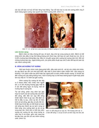 Beänh Lyù Xöông Khôùp Phaàn meàm 342
caùc taïo coát baøo vaø huyû coát baøo taêng hoaït ñoäng. Taïo coát baøo taïo ra caùc beø xöông phaûn öùng ôû
döôùi maøng ngoaøi xöông, bao quanh caùc maûnh xöông cheát. (Hình 11)
Hình 11 : A. Loã doø muû ra da (muõi teân); B. Maûnh xöông tuø (*), naèm giöõa ñöôøng doø muû.
Lieân heä laâm saøng:
Beänh nhaân coù trieäu chöùng soát cao, ôùn laïnh, ñau choùi taïi vuøng xöông bò vieâm. Beänh coù theå
chöõa khoûi neáu ñieàu trò kòp thôøi baèng khaùng sinh thích hôïp, keát hôïp vôùi raïch thoaùt löu muû. Coù töø
5-25% tröôøng hôïp khoâng ñaùp öùng ñieàu trò, chuyeån sang vieâm xöông tuyû xöông maõn tính. Ñoái vôùi
nhöõng tröôøng hôïp naøy, ngoaøi khaùng sinh, coøn phaûi phaãu thuaät naïo veùt oå vieâm ñeå loaïi boû toaøn boä
caùc maûnh xöông cheát.
B. VIEÂM LAO XÖÔNG TUYÛ XÖÔNG
Vieät nam thuoäc nhoùm nöôùc ñang phaùt trieån, ñieàu kieän kinh teá - xaõ hoäi coøn nhieàu khoù khaên,
do vaäy beänh lao vaãn coøn khaù phoå bieán, ñaëc bieät ôû nhoùm beänh nhaân nhieãm HIV. Öôùc löôïng coù
khoaûng 1-3% beänh nhaân lao phoåi hoaëc lao ngoaøi phoåi coù keøm nhieãm khuaån xöông. Vi khuaån lao
ñeán xöông chuû yeáu baèng ñöôøng maùu, moät ít tröôøng hôïp coù theå theo ñöôøng baïch huyeát hoaëc phaùt
taùn tröïc tieáp töø 1 oå vieâm lao gaàn xöông.
Vieâm xöông tuûy xöông do lao xaûy
ra ôû thanh thieáu nieân nhieàu hôn ngöôøi
lôùn; vò trí toån thöông thöôøng gaëp nhaát laø
ôû caùc ñoát soáng ngöïc vaø buïng, moät soá
tröôøng hôïp ôû xöông ñuøi.
Taïi coät soáng, phaûn öùng vieâm lao gaây
hoaïi töû maïnh caùc beø xöông xoáp cuûa thaân
ñoát soáng, daãn ñeán luùn xeïp ñoát soáng
khieán beänh nhaân bò guø veïo. Ñóa ñeäm coù
theå bò ñaåy ra sau, cheøn eùp leân reã thaàn
kinh vaø tuyû soáng, gaây ñau vaø yeáu lieät chi.
Chaát hoaïi töû baõ ñaäu coù theå thoaùt ra tröôùc
coät soáng taïo thaønh aùp xe laïnh vuøng cô
thaên löng, chui xuoáng döôùi vaø doø ra da
vuøng beïn ñuøi. Hình aûnh vi theå cuûa vieâm
xöông tuyû xöông do lao cuõng töông töï
vieâm lao ôû nôi khaùc, goàm caùc nang lao
baõ ñaäu hoùa, xen laãn vôùi caùc maûnh xöông
cheát. (Hình 12)
Hình 12: Ñoát soáng bò luùn xeïp (A); Toån thöông vieâm lao ôû
2 thaân ñoát soáng (*) vaø aùp xe laïnh cô thaên löng (muõi teân) (B)
 