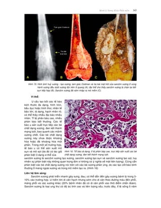Beänh Lyù Xöông Khôùp Phaàn meàm 345
Hình 15: Hình aûnh huyû xöông - taïo xöông, tam giaùc Codman vaø tia loeù maët trôøi cuûa sarcoâm xöông ôû vuøng
haønh xöông ñaàu döôùi xöông ñuøi treân X quang (A); ñaïi theå cho thaáy sarcoâm xöông bò chaën laïi bôûi
suïn tieáp hôïp (B); Sarcoâm xöông ñaõ xaâm nhaäp ra moâ meàm (C).
Vi theå:
U caáu taïo bôûi caùc teá baøo
kích thöôùc ña daïng, hình troøn,
baàu duïc hoaëc hình thoi; nhaân teá
baøo lôùn, dò daïng, haïch nhaân roõ;
coù theå thaáy nhieàu ñaïi baøo nhieàu
nhaân. Tæ leä phaân baøo cao, nhieàu
phaân baøo baát thöôøng. Caùc teá
baøo u saûn xuaát tröïc tieáp caùc beø
chaát daïng xöông, ñan keát thaønh
maïng löôùi, bao quanh caùc maûnh
xöông cheát. Caùc beø chaát daïng
xöông naøy chöa ñöôïc khoaùng
hoùa hoaëc ñaõ khoaùng hoùa moät
phaàn. Trong moät soá tröôøng hôïp,
teá baøo u coù theå saûn xuaát moâ
suïn vaø moâ sôïi (do ñoù coù taùc giaû
phaân bieät 3 daïng vi theå cuûa
Hình 16: Teáâ baøo dò daïng, tæ leä phaân baøp cao, tröïc tieáp saûn xuaát caùc beø
chaát daïng xöông, ñan keát thaønh maïng löôùi.
sarcoâm xöông laø sarcoâm xöông taïo xöông, sarcoâm xöông taïo suïn vaø sarcoâm xöông taïo sôïi; tuy
nhieân söï phaân bieät naøy khoâng quan troïng laém vì khoâng coù yù nghóa veà maët tieân löôïng). Cuõng caàn
phaân bieät caùc beø chaát daïng xöông noùi treân vôùi caùc beø xöông phaûn öùng, do caùc taïo coát baøo bình
thöôøng ôû maøng ngoaøi xöông vaø trong moâ meàm taïo ra. (Hình 16)
Lieân heä laâm saøng:
Sarcoâm xöông phaùt trieån nhanh gaây söng, ñau; coù theå daãn ñeán gaõy xöông beänh lyù trong 5-
10% caùc tröôøng hôïp. U hieám khi di caên haïch nhöng sôùm cho di caên theo ñöôøng maùu ñeán phoåi,
maøng phoåi vaø caùc xöông khaùc (20% beänh nhaân ñaõ coù di caên phoåi vaøo thôøi ñieåm chaån ñoaùn).
Sarcoâm xöông laø loaïi ung thö coù ñoä aùc tính cao vaø tieân löôïng xaáu; tröôùc ñaây, tæ leä soáng 5 naêm
 