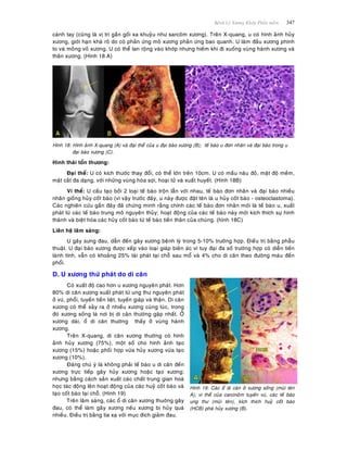 Beänh Lyù Xöông Khôùp Phaàn meàm 347
caùnh tay (cuõng laø vò trí gaàn goái xa khuyûu nhö sarcoâm xöông). Treân X-quang, u coù hình aûnh huûy
xöông, giôùi haïn khaù roõ do coù phaûn öùng moâ xöông phaûn öùng bao quanh. U laøm ñaàu xöông phình
to vaø moûng voû xöông. U coù theå lan roäng vaøo khôùp nhöng hieám khi ñi xuoáng vuøng haønh xöông vaø
thaân xöông. (Hình 18 A)
Hình 18: Hình aûnh X-quang (A) vaø ñaïi theå cuûa u ñaïi baøo xöông (B); teá baøo u ñôn nhaân vaø ñaïi baøo trong u
ñaïi baøo xöông (C).
Hình thaùi toån thöông:
Ñaïi theå: U coù kích thöôùc thay ñoåi, coù theå lôùn treân 10cm. U coù maàu naâu ñoû, maät ñoä meàm,
maët caét ña daïng, vôùi nhöõng vuøng hoùa sôïi, hoaïi töû vaø xuaát huyeát. (Hình 18B)
Vi theå: U caáu taïo bôûi 2 loaïi teá baøo troän laãn vôùi nhau, teá baøo ñôn nhaân vaø ñaïi baøo nhieàu
nhaân gioáng huûy coát baøo (vì vaäy tröôùc ñaây, u naøy ñöôïc ñaët teân laø u huûy coát baøo - osteoclastoma).
Caùc nghieân cöùu gaàn ñaây ñaõ chöùng minh raèng chính caùc teá baøo ñôn nhaân môùi laø teá baøo u, xuaát
phaùt töø caùc teá baøo trung moâ nguyeân thuûy; hoaït ñoäng cuûa caùc teá baøo naøy môùi kích thích söï hình
thaønh vaø bieät hoùa caùc huûy coát baøo töø teá baøo tieàn thaân cuûa chuùng. (hình 18C)
Lieân heä laâm saøng:
U gaây söng ñau, daãn ñeán gaõy xöông beänh lyù trong 5-10% tröôøng hôïp. Ñieàu trò baèng phaãu
thuaät. U ñaïi baøo xöông ñöôïc xeáp vaøo loaïi giaùp bieân aùc vì tuy ñaïi ña soá tröôøng hôïp coù dieãn tieán
laønh tính, vaãn coù khoaûng 25% taùi phaùt taïi choã sau moå vaø 4% cho di caên theo ñöôøng maùu ñeán
phoåi.
D. U xöông thöù phaùt do di caên
Coù xuaát ñoä cao hôn u xöông nguyeân phaùt. Hôn
80% di caên xöông xuaát phaùt töø ung thö nguyeân phaùt
ôû vuù, phoåi, tuyeán tieàn lieät, tuyeán giaùp vaø thaän. Di caên
xöông coù theå xaûy ra ôû nhieàu xöông cuøng luùc, trong
ñoù xöông soáng laø nôi bò di caên thöôøng gaëp nhaát. ÔÛ
xöông daøi, oå di caên thöôøng thaáy ôû vuøng haønh
xöông.
Treân X-quang, di caên xöông thöôøng coù hình
aûnh huûy xöông (75%), moät soá cho hình aûnh taïo
xöông (15%) hoaëc phoái hôïp vöøa huûy xöông vöøa taïo
xöông (10%).
Ñaùng chuù yù laø khoâng phaûi teá baøo u di caên ñeán
xöông tröïc tieáp gaây huûy xöông hoaëc taïo xöông;
nhöng baèng caùch saûn xuaát caùc chaát trung gian hoaù
hoïc taùc ñoäng leân hoaït ñoäng cuûa caùc huyû coát baøo vaø
taïo coát baøo taïi choã. (Hình 19)
Treân laâm saøng, caùc oå di caên xöông thuôøng gaây
ñau, coù theå laøm gaõy xöông neáu xöông bò huûy quaù
nhieàu. Ñieàu trò baèng tia xaï vôùi muïc ñích giaûm ñau.
Hình 19: Caùc oå di caên ôû xöông soáng (muõi teân
A); vi theå cuûa carcinoâm tuyeán vuù, caùc teá baøo
ung thö (muõi teân), kích thích huyû coát baøo
(HCB) phaù huûy xöông (B).
 