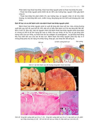 Beänh Lyù Xöông Khôùp Phaàn meàm 350
Phaân bieät 2 loaïi thoaùi hoaù khôùp, thoaùi hoaù khôùp nguyeân phaùt vaø thoaùi hoaù khôùp thöù phaùt.
- Thoaùi hoaù khôùp nguyeân phaùt chieám ña soá, 95% caùc tröôøng hôïp; nguyeân nhaân gaây beänh
chöa roõ.
- Thoaùi hoaù khôùp thöù phaùt chieám 5% caùc tröôøng hôïp, coù nguyeân nhaân roõ reät nhö chaán
thöông, hö maët khôùp baåm sinh, nhieãm truøng, laéng ñoïng caùc tinh theå muoái khoaùng treân maët
khôùp…
Dòch teã hoïc vaø cô cheá beänh sinh cuûa beänh thoaùi hoaù khôùp nguyeân phaùt:
Beänh thoaùi hoaù khôùp nguyeân phaùt coù xuaát ñoä taêng daàn theo tuoåi taùc: trieäu chöùng thuôøng
xuaát hieän sau tuoåi 40; qua tuoåi 50, 40% daân soá coù bieåu hieän beänh vaø tæ leä naøy taêng daàn ñeán 80-
90% ôû tuoåi 70. Nhö vaäy, maëc duø nguyeân nhaân cuûa beänh thoaùi hoaù khôùp nguyeân phaùt chöa ñöôïc
roõ nhöng coù theå laø do tình traïng laõo hoaù töï nhieân cuûa suïn khôùp; thí duï nhö söï gia taêng haøm
löôïng nöôùc cuûa suïn khôùp, söï thoaùi hoaù caùc sôïi collagen vaø proteoglycan, söï gia taêng hoaït ñoäng
tieâu huûy chaát neàn suïn cuûa caùc teá baøo suïn. Beänh thoaùi hoaù khôùp nguyeân phaùt hay xaûy ra ôû
nhöõng khôùp phaûi chòu taûi naëng nhö khôùp haùng, khôùp goái, caùc khôùp lieân ñoát soáng coå.
Hình 21: Söï hình thaønh caùc toån thöông trong beänh thoaùi hoaù khôùp
Hình 22: Vuøng baûn xöông döôùi suïn loä ra (*) (A); Vuøng baûn xöông döôùi suïn loä ra (1), boïc döôùi suïn (2), phaàn
suïn khôùp chöa bong (3) (B); Veát nöùt treân beà maët suïn khôùp (C); Boïc döôùi suïn (muõi teân) (D).
 