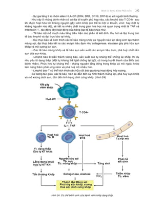 Beänh Lyù Xöông Khôùp Phaàn meàm 352
- Söï gia taêng tæ leä nhoùm allen HLA-DR (DR4, DR1, DR10, DR14) so vôùi ngöôøi bình thöôøng.
Nhö vaäy ôû nhöõng beänh nhaân coù cô ñòa di truyeàn phuø hôïp naøy, caùc limphoâ baøo T CD4+ sau
khi ñöôïc hoaït hoùa bôûi khaùng nguyeân gaây vieâm khôùp (coù theå laø moät vi khuaån, viruùt hay moät töï
khaùng nguyeân naøo ñoù), seõ tieát ra nhieàu chaát trung gian hoùa hoïc maø quan troïng nhaát laø TNF vaø
Interleulin-1 , taùc ñoäng leân hoaët ñoäng cuûa haøng loaït teá baøo khaùc nhö:
- Teá baøo noäi moâ maïch maùu taêng bieåu hieän caùc phaân töû keát dính, thu huùt vaø taäp trung caùc
teá baøo limphoâ vaø ñaïi thöïc baøo taïi khôùp.
- Ñaïi thöïc baøo seõ kích thích caùc teá baøo maøng khôùp vaø nguyeân baøo sôïi taêng sinh taïo thaønh
maûng sôïi, ñaïi thöïc baøo tieát ra caùc enzym tieâu ñaïm nhö collagenase, elastase gaây phaù huûy suïn
khôùp vaø moâ xöông laân caän.
- Caùc teá baøo maøng khôùp vaø teá baøo suïn saûn xuaát caùc enzym tieâu ñaïm, phaù huyû chaát neàn
suïn cuûa suïn khôùp.
- Limphoâ baøo B bieán thaønh töông baøo, saûn xuaát caùc töï khaùng theå choáng laïi khôùp, thí duï
nhö yeáu toá daïng thaáp (Moät töï khaùng theå IgM choáng laïi IgG, coù trong huyeát thanh cuûa 80% caùc
beänh nhaân). Phöùc hôïp töï khaùng theå - khaùng nguyeân laéng ñoäng trong khôùp vaø moâ ngoaøi khôùp
laøm naëng theâm phaûn öùng vieâm vaø phaù huyû moâ nhieàu hôn.
- Limphoâ baøo T coù theå kích thích caùc huûy coát baøo gia taêng hoaït ñoäng huûy xöông.
Söï töông taùc giöõa caùc teá baøo treân seõ daãn ñeán söï hình thaønh maûng sôïi, phaù huûy suïn khôùp
vaø moâ xöông döôùi suïn, daãn ñeán tình traïng dính cöùng khôùp. (Hình 24)
Hình 24: Cô cheá beänh sinh cuûa beänh vieâm khôùp daïng thaáp
 