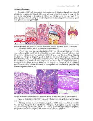 Beänh Lyù Xöông Khôùp Phaàn meàm 353
Hình thaùi toån thöông:
Trong beänh VKDT, toån thöông khôùp thöôøng coù tính chaát ñoái xöùng, xaûy ra ôû caùc khôùp nhoû
cuûa baøn tay vaø baøn chaân, khôùp coå chaân, khôùp goái, khôùp coå tay, khôùp khuyûu vaø khôùp vai. Khi
khôùp bò phaù huyû, hoaù sôïi vaø dính cöùng; coù theå thaáy caùc bieán daïng khôùp nhö ngoùn tay leäch truï,
coå tay leänh quay. Treân X-quang, coù hình aûnh heïp khe khôùp do maát suïn khôùp, moâ xöông quanh
khôùp giaûm ñoä caûn quang (Hình 23B).
Hình 25: Maøng khôùp bình thöôøng (A), Taêng sinh teá baøo maøng khôùp (B), Maøng khôùp taïo nhuù (C), Maûng sôïi
phuû leân suïn khôùp (D), hoaù sôïi vaø hoaù voâi gaây cöùng dính khôùp (E).
Hình aûnh vi theå trong giai ñoaïn ñaàu cuûa beänh VKDT cho thaáy maøng khôùp bò phuø neà, thaám
nhaäp nhieàu töông baøo, limphoâ baøo vaø ñaïi thöïc baøo; caùc maïch maùu taân sinh, dòch xuaát fibrin ñöôïc
tieát ra treân beà maët bao khôùp hoaëc taïo thaønh haït troâi noåi töï do trong dòch khôùp. Maøng khôùp daày
leân, do teá baøo maøng khôùp taêng sinh, goàm 8-10 lôùp teá baøo (so vôùi bình thöôøng chæ coù 3-4 lôùp); moâ
ñeäm chöùa nhieàu töông baøo, limphoâ baøo vaø caùc nang limphoâ. Maøng khôùp gaáp neáp taïo thaønh nhuù
thoø vaøo khoang khôùp, hình thaønh maûng sôïi (pannus) che phuû beà maët suïn khôùp laøm noù bò caùch ly
khoûi nguoàn nuoâi döôõng laø dòch khôùp. Keát quaû laø suïn khôùp vaø baûn xöông döôùi suïn seõ bò phaù huûy
daàn. Cuoái cuøng, maûng sôïi xaâm chieám toaøn boä khoang khôùp, hoaù sôïi vaø hoaù voâi, gaây dính cöùng
vaø bieán daïng khôùp. (hình 25, 26)
Hình 26: Teá baøo maøng khôùp taêng sinh (A), Maøng khôùp taïo nhuù (B), Maûng sôïi (*) phuû leân maët suïn khôùp (C).
Ngoaøi ra, ôû caùc beänh nhaân VKDT naëng, coù theå gaëp theâm nhöõng toån thöông khaùc ngoaøi
khôùp nhö:
- Noát thaáp döôùi da (rheumatoid nodule), ñöôïc thaáy ôû 25% beänh nhaân. Noát coù hình troøn
hoaëc baàu duïc, ñöôøng kính 2cm, maät ñoä chaéc, khoâng ñau, thöôøng gaëp ôû caúng tay, khuyûu tay,
vuøng chaåm vaø löng döôùi. Veà vi theå, caáu taïo cuûa noát thaáp goàm moät trung taâm hoaïi töû daïng fibrin,
bao quanh bôûi caùc teá baøo daïng bieåu moâ, limphoâ baøo vaø töông baøo. (Hình 27)
 