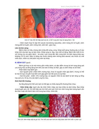 Beänh Lyù Xöông Khôùp Phaàn meàm 354
Hinh 27: Ñaïi theå noát thaáp döôùi da (A); vi theå: trung taâm hoaïi töû daïng fibrin (*,B)
- Vieâm maïch hoaïi töû caáp tính (acute necrotizing vasculitis), vieâm maøng tim tô huyeát, vieâm
maøng phoåi tô huyeát, vieâm moáng maét, vieâm keát - giaùc maïc.
Lieân heä laâm saøng:
Beänh nhaân coù trieäu chöùng vieâm khôùp ñoái xöùng, cöùng khôùp buoåi saùng; thöôøng xaûy ra ôû caùc
khôùp nhoû cuûa baøn tay vaø baøn chaân. Khôùp söng to, ñau, haïn cheá cöû ñoäng. Beänh tieán trieån töø töø,
vôùi nhöõng chu kyø giaûm beänh - taùi phaùt, cuoái cuøng daãn ñeán cöùng dính vaø bieán daïng khôùp sau
khoaûng 10-15 naêm. Ñieàu trò baèng caùc thuoác khaùng vieâm khoâng phaûi steroid, caùc thuoác öùc cheá
mieãn dòch, nhaèm öùc cheá phaûn öùng vieâm taïi khôùp.
III. BEÄNH GUÙT (gout):
Beänh guùt thöïc ra laø moät nhoùm goàm nhieàu beänh, coù ñaëc ñieåm chung laø tình traïng taêng axít
uric trong maùu vaø laéng ñoïng tinh theå urat natri ôû khôùp vaø thaän, gaây ra vieâm khôùp vaø soûi thaän.
Phaân bieät 2 loaïi beänh guùt:
- Guùt nguyeân phaùt: chieám 90% tröôøng hôïp, chöa roõ nguyeân nhaân gaây beänh, nhöng coù theå
laø moät roái loaïn chuyeån hoaù baåm sinh gaây giaûm baøi tieát acid uric taïi thaän.
- Guùt thöù phaùt: chieám 10% tröôøng hôïp, coù nguyeân nhaân laø caùc beänh lyù laøm taêng söï toång
hôïp axít uric, thí duï nhö caùc beänh ung thö maùu.
Hình thaùi toån thöông:
Söï laéng ñoïng tinh theå uraùt natri coù theå gaây ra nhieàu daïng toån thöông khaùc nhau:
- Vieâm khôùp caáp: baïch caàu ña nhaân thaám nhaäp vaøo bao khôùp vaø dòch khôùp. Bao khôùp
sung huyeát, phuø neà. Coù theå thaáy caùc tinh theå uraùt natri hình kim naèm trong baøo töông baïch caàu
ña nhaân hoaëc keát thaønh ñaùm nhoû trong bao khôùp. (Hình 28)
Hình 28: Vieâm khôùp caáp do guùt (A); Tinh theå uraùt natri hình kim thaáy ñöôïc döôùi kính hieån vi phaân cöïc
 