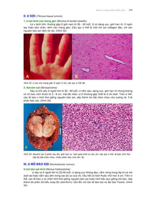 Beänh Lyù Xöông Khôùp Phaàn meàm 358
II. U SÔÏI ( Fibrous tissue tumors)
1. U sôïi laønh cuûa maøng gaân (fibroma of tendon sheath):
Laø u laønh tính, thöôøng gaëp ôû giôùi nam töø 30 - 50 tuoåi. U coù daïng cuïc, giôùi haïn roõ, ôû ngoùn
tay hoaëc baøn chaân, dính vaøo maøng gaân. Caáu taïo vi theå laø moät moâ sôïi collagen ñaëc, vôùi caùc
nguyeân baøo sôïi naèm raûi raùc. (Hình 32)
Hình 32: U sôïi cuûa maøng gaân ôû ngoùn 3 (A); caáu taïo vi theå (B)
2. Sarcoâm sôïi (fibrosarcoma):
Xaûy ra chuû yeáu ôû ngöôøi lôùn töø 30 - 60 tuoåi. U naèm saâu, daïng cuïc, giôùi haïn roõ nhöng khoâng
coù voû bao, kích thöôùc töø 3 - 8 cm, maät ñoä chaéc; vò trí thöôøng gaëp nhaát laø ôû chi döôùi. Treân vi theå,
caùc teá baøo u hình thoi gioáng nguyeân baøo sôïi, xeáp thaønh boù baét cheùo nhau nhö xöông caù, tæ leä
phaân baøo cao. (Hình 33)
Hình 33: Sarcoâm sôïi ôû phaàn sau ñuøi, giôùi haïn roï, naèm giöõa khoái cô vaân (A); caáu taïo vi theå, teá baøo hình thoi
xeáp boù baét cheùo nhau, nhieàu phaân baøo (muõi teân, B).
III. U MOÂ BAØO SÔÏI (fibrohistiocytic tumors):
U moâ baøo sôïi laønh (fibrous histiocytoma):
U xaûy ra ôû ngöôøi lôùn töø 20-40 tuoåi. U daïng cuïc khoâng ñau, naèm noâng trong lôùp bì vaø moâ
döôùi da hoaëc naèm saâu beân trong caùc boù cô cuûa chi, haàu heát coù kích thöôùc nhoû hôn 3 cm; Treân vi
theå, caùc teá baøo u coù nhaân hình thoi gioáng nguyeân baøo sôïi hoaëc hình baàu duïc gioáng moâ baøo, xeáp
thaønh boù phaân boá kieåu xoaùy loác (storiform), troän laãn vôùi caùc teá baøo boït vaø ñaïi baøo Touton. (Hình
34)
 