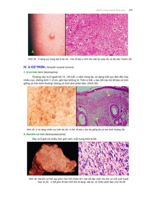 Beänh Lyù Xöông Khôùp Phaàn meàm 359
Hình 34 : U daïng cuïc trong lôùp bì da (A) ; Caùc teá baøo u hình thoi xeáp boù xoaùy loác vaø ñaïi baøo Touton (B).
IV. U CÔ TRÔN ( Smooth muscle tumors)
1. U cô trôn laønh (leiomyoma):
Thöôøng xaûy ra ôû ngöôøi treû 15 - 25 tuoåi, u naèm trong da, coù daïng moät cuïc ñôn ñoäc hay
nhieàu cuïc, ñöôøng kính 1- 2 cm, giôùi haïn khoâng roõ. Treân vi theå, u taïo bôûi caùc boù teá baøo cô trôn
gioáng cô trôn bình thöôøng; khoâng coù hình aûnh phaân baøo. (Hình 35)
Hình 35: U coù daïng nhieàu cuïc treân da (A); vi theå, teá baøo u taïo boù gioáng boù cô trôn bình thöôøng (B)
2. Sarcoâm cô trôn (leiomyosarcoma):
Xaûy ra ôû giôùi nöõ nhieàu hôn giôùi nam, tuoåi trung bình laø 60.
Hình 36: Sarcoâm cô trôn sau phuùc maïc kích thöôùc lôùn, maët caét ñaëc chaéc nhö thòt, coù choã xuùaât huyùeát
hoaïi töû (A); vi theå goàm teá baøo hình thoi dò daïng, xeáp boù, coù nhieàu phaân baøo (muõi teân,B)
 