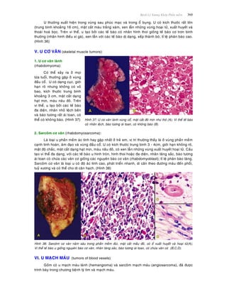 Beänh Lyù Xöông Khôùp Phaàn meàm 360
U thöôøng xuaát hieän trong vuøng sau phuùc maïc vaø trong oå buïng. U coù kích thöôùc raát lôùn
(trung bình khoaûng 16 cm), maët caét maøu traéng xaùm, xen laãn nhöõng vuøng hoaïi töû, xuaát huyeát vaø
thoaùi hoaù boïc. Treân vi theå, u taïo bôûi caùc teá baøo coù nhaân hình thoi gioáng teá baøo cô trôn bình
thöôøng (nhaân hình ñieáu xì gaø), xen laãn vôùi caùc teá baøo dò daïng, xeáp thaønh boù; tæ leä phaân baøo cao.
(Hình 36)
V. U CÔ VAÂN (skeletal muscle tumors):
1. U cô vaân laønh
(rhabdomyoma):
Coù theå xaûy ra ôû moïi
löùa tuoåi, thöôøng gaëp ôû vuøng
ñaàu coå. U coù daïng cuïc, giôùi
haïn roõ nhöng khoâng coù voû
bao, kích thöôùc trung bình
khoaûng 3 cm, maët caét daïng
haït mòn, maøu naâu ñoû. Treân
vi theå, u taïo bôûi caùc teá baøo
ña dieän, nhaân nhoû leäch beân
vaø baøo töông raát aùi toan, coù
theå coù khoâng baøo. (Hình 37) Hình 37: U cô vaân laønh vuøng coå, maët caét ñoû mòn nhö thòt (A); Vi theå teá baøo
coù nhaân leäch, baøo töông aùi toan, coù khoâng baøo (B).
2. Sarcoâm cô vaân (rhabdomyosarcoma):
Laø loaïi u phaàn meàm aùc tính hay gaëp nhaát ôû treû em, vò trí thöôøng thaáy laø ôû vuøng phaàn meàm
caïnh tinh hoaøn, aâm ñaïo vaø vuøng ñaàu coå. U coù kích thöôùc trung bình 3 - 4cm, giôùi haïn khoâng roõ,
maät ñoä chaéc, maët caét daïng haït mòn, maøu naâu ñoû, coù xen laãn nhöõng vuøng xuaát huyeát hoaïi töû. Caáu
taïo vi theå ña daïng, vôùi caùc teá baøo u hình troøn, hình thoi hoaëc ña dieän, nhaân taêng saéc, baøo töông
aùi toan coù chöùa caùc vaân cô gioáng caùc nguyeân baøo cô vaân (rhabdomyoblast); tæ leä phaân baøo taêng.
Sarcoâm cô vaân laø loaïi u coù ñoä aùc tính cao, phaùt trieån nhanh, di caên theo ñöôøng maùu ñeán phoåi,
tuyû xöông vaø coù theå cho di caên haïch. (Hình 38)
Hình 38: Sarcoâm cô vaân naèm saâu trong phaàn meàm ñuøi, maët caét maàu ñoû, coù oå xuaát huyeát vaø hoaïi töû(A);
Vi theå teá baøo u gioáng nguyeân baøo cô vaân, nhaân taêng saéc, baøo töông aùi toan, coù chöùa vaân cô (B,C,D).
VI. U MAÏCH MAÙU (tumors of blood vesels)
Goàm coù u maïch maùu laønh (hemangioma) vaø sarcoâm maïch maùu (angiosarcoma), ñaõ ñöôïc
trình baøy trong chöông beänh lyù tim vaø maïch maùu.
 
