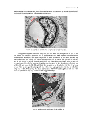 Vieâm vaø söûa chöõa 35
maøng ñaùy vaø ñöôïc lieân keát vôùi nhau baèng lieân keát voøng bòt (Hình 4); do ñoù caùc protein huyeát
töông trong loøng maïch khoâng theå thoaùt vaøo moâ keõ ñöôïc.
Hình 4: Teá baøo noäi moâ lieân keát nhau baèng lieân keát voøng bòt (muõi teân)
Trong phaûn öùng vieâm, caùc chaát trung gian hoùa hoïc ñöôïc giaûi phoùng töø caùc teá baøo vaø moâ
toån thöông nhö histamin, seretonin, yeáu toá hoaït hoùa tieåu caàu (PAF: platelet activating factor),
prostaglandin, leukotrien, saûn phaåm giaùng hoùa töø fibrin, bradykinin seõ taùc ñoäng leân tieåu tónh
maïch baèng caùch gaén keát vôùi caùc thuï theå töông öùng coù treân beà maët teá baøo noäi moâ. Söï gaén keát
laøm teá baøo noäi moâ co laïi, ñeå loä ra caùc khoaûng hôû cho pheùp caùc protein huyeát töông loït vaøo moâ
keõ ngoaøi maïch (Hình 5). Söï gia taêng noàng ñoä protein trong moâ keõ laøm taêng aùp löïc thaåm thaáu keo
taïi ñaây, keát quaû nöôùc vaø chaát ñieän giaûi ñaõ bò ñaåy ra ngoaøi do söï taêng aùp löïc thuûy tónh thì laïi caøng
bò keùo theâm ra, laøm gia taêng löôïng dòch phuø vieâm. Hieän töôïng phuø vieâm naøy taïo ra bieåu hieän
söng cuûa oå vieâm. Trieäu chöùng ñau laø do caùc taän cuøng thaàn kinh bò caêng giaõn do dòch phuø vieâm
hoaëc do bò kích thích tröïc tieáp bôûi caùc chaát trung gian hoùa hoïc.
Hình 5: Teá baøo noäi moâ co laïi, ñeå loä ra caùc khoaûng hôû
 