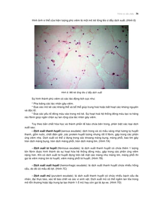 Vieâm vaø söûa chöõa 36
Hình aûnh vi theå cuûa hieän töôïng phuø vieâm laø moät moâ keõ loûng leûo öù ñaày dòch xuaát. (Hình 6)
Hình 6: Moâ keõ loûng leûo öù ñaày dòch xuaát
Söï hình thaønh phuø vieâm coù caùc taùc ñoäng tích cöïc nhö:
* Pha loaõng caùc taùc nhaân gaây vieâm.
* Ñöa vaøo moâ keõ caùc khaùng theå vaø boå theå giuùp trung hoaø hoaëc baát hoaït caùc khaùng nguyeân
vaø ñoäc toá.
* Ñöa caùc yeáu toá ñoâng maùu vaøo trong moâ keõ. Söï hoaït hoaù heä thoáng ñoâng maùu taïo ra haøng
raøo fibrin giuùp ngaên chaën söï lan roäng cuûa taùc nhaân gaây vieâm.
Tuøy theo baûn chaát hoùa hoïc vaø thaønh phaàn teá baøo chöùa beân trong, phaân bieät caùc loaïi dòch
xuaát sau:
- Dòch xuaát thanh huyeát (serous exudate): dòch trong vaø coù maàu vaøng nhaït töông töï huyeát
thanh, goàm nöôùc, chaát ñieän giaûi ,caùc protein huyeát töông nhöng raát ít fibrin, gaëp trong caùc phaûn
öùng vieâm nheï. Dòch xuaát coù theå öù ñoïng trong caùc khoang maøng buïng, maøng phoåi, bao tim gaây
traøn dòch maøng buïng, traøn dòch maøng phoåi, traøn dòch maøng tim. (Hình 7A)
- Dòch xuaát tô huyeát (fibrinous exudate): laø dòch xuaát thanh huyeát coù chöùa theâm 1 löôïng
lôùn fibrin ñöôïc hình thaønh do söï hoaït hoùa heä thoáng ñoâng maùu, gaëp trong caùc phaûn öùng vieâm
naëng hôn. Khi coù dòch xuaát tô huyeát ñoïng treân beà maët caùc maøng nhö maøng tim, maøng phoåi thì
goïi laø vieâm maøng tim tô huyeát, vieâm maøng phoåi tô huyeát. (Hình 7B)
- Dòch xuaát xuaát huyeát (hemorrhagic exudate): laø dòch xuaát thanh huyeát chöùa nhieàu hoàng
caàu, do ñoù coù maàu ñoû lôït. (Hình 7C)
- Dòch xuaát muû (purulent exudate): laø dòch xuaát thanh huyeát coù chöùa nhieàu baïch caàu ña
nhaân, ñaïi thöïc baøo, xaùc teá baøo cheát vaø caùc vi sinh vaät. Dòch xuaát muû coù theå ngaám lan toûa trong
moâ toån thöông hoaëc taäp trung laïi taïo thaønh 1 oå muû hay coøn goïi laø aùp-xe. (Hình 7D)
 