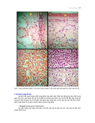 Vieâm vaø söûa chöõa 37
Hình 7: Dòch xuaát thanh huyeát (*) (A); Dòch xuaát tô huyeát (*) (B); Dòch xuaát xuaát huyeát (C); Dòch xuaát muû (D)
3. Söï thaáâm nhaäp teá baøo
Laø bieán ñoåi quan troïng nhaát trong phaûn öùng vieâm caáp. Döôùi taùc ñoäng cuûa caùc chaát trung
gian hoùa hoïc, caùc baïch caàu seõ di chuyeån töø trong loøng maïch vaøo moâ keõ ñeå ñeán taäp trung taïi
vuøng moâ toån thöông. Söï di chuyeån cuûa baïch caàu cuõng xaûy ra chuû yeáu taïi caùc tieåu tónh maïch,
goàm 3 giai ñoaïn laø tuï vaùch, xuyeân maïch vaø hoùa öùng ñoäng.
- Tuï vaùch (margination & adherence):
Laø hieän töôïng caùc baïch caàu baùm vaøo beà maët caùc teá baøo noäi moâ, chuû yeáu taïi tieåu tónh
maïch (Hình 8, 9).
 