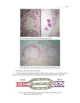Vieâm vaø söûa chöõa 38
Hình 8: Tuï vaùch, baïch caàu baùm vaøo beà maët caùc teá baøo noäi moâ
Hình 9: Hieän töôïng tuï vaùch xaûy ra ôû tieåu tónh maïch, khoâng thaáy ôû tieåu ñoäng maïch
Hieän töôïng tuï vaùch xaûy ra do 2 cô cheá sau:
* Tình traïng sung huyeát ñoäng vaø taêng tính thaám thaønh maïch laøm maùu bò coâ ñaëc hôn vaø
chaûy chaäm laïi, thuaän lôïi cho söï tieáp caän giöõa baïch caàu vaø beà maët teá baøo noäi moâ. (Hình 10)
Hình 10: Maùu coâ ñaëc vaø chaûy chaäm, thuaän lôïi cho söï tieáp caän giöõa baïch caàu vaø teá
baøo noäi moâ taïi vuøng tieåu tónh maïch.
 