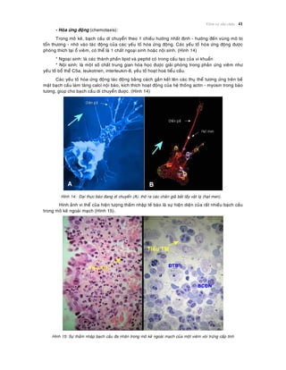 Vieâm vaø söûa chöõa 41
- Hoùa öùng ñoäng (chemotaxis):
Trong moâ keõ, baïch caàu di chuyeån theo 1 chieàu höôùng nhaát ñònh - höôùng ñeán vuøng moâ bò
toån thöông - nhôø vaøo taùc ñoäng cuûa caùc yeáu toá hoùa öùng ñoäng. Caùc yeáu toá hoùa öùng ñoäng ñöôïc
phoùng thích taïi oå vieâm, coù theå laø 1 chaát ngoaïi sinh hoaëc noäi sinh. (Hình 14)
* Ngoaïi sinh: laø caùc thaønh phaàn lipid vaø peptid coù trong caáu taïo cuûa vi khuaån
* Noäi sinh: laø moät soá chaát trung gian hoùa hoïc ñöôïc giaûi phoùng trong phaûn öùng vieâm nhö
yeáu toá boå theå C5a, leukotrien, interleukin-8, yeáu toá hoaït hoaù tieåu caàu.
Caùc yeáu toá hoùa öùng ñoäng taùc ñoäng baèng caùch gaén keát leân caùc thuï theå töông öùng treân beà
maët baïch caàu laøm taêng calci noäi baøo, kích thích hoaït ñoäng cuûa heä thoáng actin - myosin trong baøo
töông, giuùp cho baïch caàu di chuyeån ñöôïc. (Hình 14)
Hình 14: Ñaïi thöïc baøo ñang di chuyeån (A); thoø ra caùc chaân giaû baét laáy vaät laï (haït men).
Hình aûnh vi theå cuûa hieän töôïng thaám nhaäp teá baøo laø söï hieän dieän cuûa raát nhieàu baïch caàu
trong moâ keõ ngoaøi maïch (Hình 15).
Hình 15: Söï thaám nhaäp baïch caàu ña nhaân trong moâ keõ ngoaøi maïch cuûa moät vieâm voøi tröùng caáp tính
 