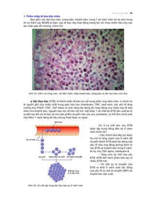 Vieâm vaø söûa chöõa 46
1. Thaám nhaäp teá baøo ñôn nhaân
Bao goàm caùc ñaïi thöïc baøo, töông baøo, limphoâ baøo; trong 1 soá vieâm maõn do kyù sinh truøng
thì coù theâm caùc BCÑN aùi toan; caùc teá baøo naøy hoaït ñoäng töông taùc vôùi nhau nhaèm tieâu huûy caùc
taùc nhaân gaây toån thöông. (Hình 23)
Hình 23: Vieâm voøi tröùng maõn, moâ ñeäm thaám nhaäp limphoâ baøo, töông baøo vaø ñaïi thöïc baøo (muõi teân)
a/ Ñaïi thöïc baøo (ÑTB): laø thaønh phaàn teá baøo truï coät trong phaûn öùng vieâm maõn, vì chính noù
laø nguoàn goác cuûa nhieàu chaát trung gian hoùa hoïc (Interleukin, TNF, oxid nitric, caùc yeáu toá taêng
tröôûng nhö PGDF, FGF, TGF beâta) coù khaû naêng taùc ñoäng leân hoaït ñoäng cuûa nhieàu loaïi teá baøo
khaùc nhö limphoâ baøo, nguyeân baøo sôïi, teá baøo noäi moâ; maët khaùc 1 soá chaát do ÑTB saûn xuaát laïi toû
ra ñoäc haïi ñoái vôùi teá baøo vaø moâ (saûn phaåm chuyeån hoùa cuûa oxy, protease), coù theå laøm moâ bò phaù
huûy theâm 1 caùch ñaùng keå neáu chuùng thoaùt ñöôïc ra ngoaøi.
Hình 24: Cô cheá taäp trung ñaïi thöïc baøo taïi oå vieâm maõn
Coù 3 cô cheá laøm cho ÑTB
ñöôïc taäp trung ñoâng ñaûo taïi oå vieâm
maõn (Hình 24):
- Caùc moânoâ baøo tieáp tuïc ñöôïc
thu huùt töø loøng maïch vaøo oå vieâm ñeå
chuyeån thaønh ÑTB döôùi taùc ñoäng cuûa
yeáu toá hoùa öùng ñoäng phoùng thích töø
caùc ÑTB vaø limphoâ baøo trong oå vieâm,
thí duï nhö TNF alpha, interleukin-8.
- Taêng sinh taïi choã cuûa caùc
ÑTB: ÑTB tieán haønh phaân baøo taïo ra
nhieàu ÑTB môùi.
- ÖÙc cheá söï di chuyeån cuûa
ÑTB ra khoûi oå vieâm döôùi taùc ñoäng
cuûa yeáu toá öùc cheá di chuyeån (MIF) do
limphoâ baøo saûn xuaát.
 