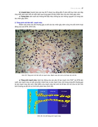 Vieâm vaø söûa chöõa 47
b/ Limphoâ baøo: limphoâ baøo caùc loaïi (B,T) ñöôïc huy ñoäng ñeán oå vieâm ñeå thöïc hieän caùc ñaùp
öùng mieãn dòch dòch theå vaø mieãn dòch qua trung gian teá baøo nhaèm tieâu huûy taùc nhaân gaây vieâm.
c/ Töông baøo: saûn xuaát caùc khaùng theå ñaëc hieäu choáng laïi caùc khaùng nguyeân coù trong caùc
taùc nhaân gaây vieâm.
2. Taêng sinh moâ lieân keát - maïch maùu
Nhaèm söûa chöõa caùc toån thöông gaây ra bôûi caùc taùc nhaân gaây vieâm cuõng nhö bôûi chính hoaït
ñoäng cuûa caùc ÑTB. (Hình 25)
Hình 25: Taêng sinh moâ lieân keát vaø maïch maùu. Maïch maùu taân sinh coù teá baøo noäi moâ lôùn
a/ Taêng sinh maïch maùu: döôùi taùc ñoäng cuûa caùc yeáu toá taïo maïch nhö FGF* do ÑTB saûn
xuaát, caùc maïch maùu coù saün seõ phaân nhaùnh taïo ra caùc maïch maùu môùi trong vuøng toån thöông goïi
laø caùc maïch maùu taân sinh. Ñaëc ñieåm cuûa maïch maùu taân sinh laø teá baøo noäi moâ cuûa noù lôùn hôn
bình thöôøng vaø ñoâi khi coù hình aûnh phaân baøo (hình 26).
Hình 26: Cô cheá taêng sinh maïch maùu
 