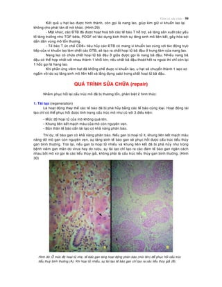 Vieâm vaø söûa chöõa 50
Keát quaû u haït lao ñöôïc hình thaønh, coøn goïi laø nang lao, giuùp kìm giöõ vi khuaån lao laïi
khoâng cho phaùt taùn ñi nôi khaùc. (Hình 29)
- Maët khaùc, caùc ÑTB ñaõ ñöôïc hoaït hoaù bôûi caùc teá baøo T hoã trôï, seõ taêng saûn xuaát caùc yeáu
toá taêng tröôûng nhö TGF beâta, PDGF coù taùc duïng kích thích söï taêng sinh moâ lieân keát, gaây hoùa sôïi
daàn daàn vuøng moâ toån thöông.
- Teá baøo T öùc cheá CD8+ tieâu huûy caùc ÑTB coù mang vi khuaån lao cuøng vôùi taùc ñoäng tröïc
tieáp cuûa vi khuaån lao laøm cheát caùc ÑTB, seõ taïo ra chaát hoaïi töû baõ ñaäu ôû trung taâm cuûa nang lao.
Nang lao coù chöùa chaát hoaïi töû baõ ñaäu ôû giöõa ñöôïc goïi laø nang baõ ñaäu. Nhieàu nang baõ
ñaäu coù theå hôïp nhaát vôùi nhau thaønh 1 khoái lôùn; neáu chaát baõ ñaäu thoaùt heát ra ngoaøi thì chæ coøn laïi
1 hoác goïi laø hang lao.
Khi phaûn öùng vieâm haït ñaõ khoáng cheá ñuôïc vi khuaån lao, u haït seõ chuyeån thaønh 1 seïo xô
ngaám voâi do söï taêng sinh moâ lieân keát vaø laéng ñoïng calci trong chaát hoaïi töû baõ ñaäu.
QUAÙ TRÌNH SÖÛA CHÖÕA (repair)
Nhaèm phuïc hoài laïi caáu truùc moâ ñaõ bò thöông toån, phaân bieät 2 hình thöùc:
1. Taùi taïo (regeneration)
Laø hoaït ñoäng thay theá caùc teá baøo ñaõ bò phaù huûy baèng caùc teá baøo cuøng loaïi. Hoaït ñoäng taùi
taïo chæ coù theå phuïc hoài ñöôïc tình traïng caáu truùc moâ nhö cuõ vôùi 3 ñieàu kieän:
- Möùc ñoä hoaïi töû cuûa moâ khoâng quaù lôùn.
- Khung lieân keát maïch maùu cuûa moâ coøn nguyeân veïn.
- Baûn thaân teá baøo caàn taùi taïo coù khaû naêng phaân baøo.
Thí duï: teá baøo gan coù khaû naêng phaân baøo. Neáu gan bò hoaïi töû ít, khung lieân keát maïch maùu
naâng ñôõ moâ gan coøn nguyeân veïn, söï taêng sinh teá baøo gan seõ phuïc hoài ñöôïc caáu truùc tieåu thuøy
gan bình thöôøng. Traùi laïi, neáu gan bò hoaïi töû nhieàu vaø khung lieân keát ñaõ bò phaù huûy nhö trong
beänh vieâm gan maõn do virus hay do röôïu, söï taùi taïo chæ taïo ra caùc ñaùm teá baøo gan ngaên caùch
nhau bôûi moâ xô goïi laø caùc tieåu thuøy giaû, khoâng phaûi laø caáu truùc tieåu thuøy gan bình thöôøng. (Hình
30)
Hình 30: ÔÛ möùc ñoä hoaïi töû nheï, teá baøo gan taêng hoaït ñoäng phaân baøo (muõi teân) ñeå phuïc hoài caáu truùc
tieåu thuyø bình thöôøng (A); Khi hoaïi töû nhieàu, söï taùi taïo teá baøo gan chæ taïo ra caùc tieåu thuøy giaû (B).
 