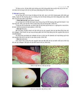 Vieâm vaø söûa chöõa 51
Teá baøo cô tim, teá baøo thaàn kinh khoâng coøn khaû naêng phaân baøo do ñoù neáu moâ cô tim vaø
moâ thaàn kinh bò hoaïi töû thì chæ coù theå söûa chöõa baèng hình thöùc hoùa seïo.
2. Hoùa seïo (scarring)
Laø söï thay theá moâ bò hoaïi töû baèng moâ lieân keát, xaûy ra khi toån thöông gaây maát chaát quaù
nhieàu, hoaëc khi toån thöông xaûy ra ôû nhöõng moâ maø teá baøo khoâng coøn khaû naêng phaân baøo. Dieãn
tieán cuûa hoaù seïo goàm 3 giai ñoaïn:
- Thaønh laäp moâ haït (granulation tissue):
Laø söï taêng sinh moâ lieân keát maïch maùu trong vuøng moâ toån thöông; keát quaû hình thaønh 1 moâ
haït maàu ñoû, meàm, beà maët loån nhoån vaø deã chaûy maùu khi ñuïng ñeán. (Hình 31)
Trong caùc toån thöông da, söï thaønh laäp moâ haït thaùi quaù seõ taïo ra 1 u giaû goïi laø u haït chuøm,
loài treân maët da (exuberant granulation). (Hình 32)
- Hoùa sôïi (fibrosis):
Moâ haït ñöôïc chuyeån thaønh moâ lieân keát sôïi do caùc nguyeân baøo sôïi gia taêng toång hôïp caùc
sôïi collagen. Kích thöôùc moâ sôïi naøy seõ ñöôïc giaûm bôùt nhôø hoaït ñoäng cuûa caùc nguyeân baøo sôïi-cô
(myofibroblast).
Söï toång hôïp quaù ñaùng sôïi collagen seõ taïo ra caùc seïo loài (keloid) coøn hoaït ñoäng quaù möùc
cuûa nguyeân baøo sôïi-cô seõ taïo ra caùc seïo co keùo. (Hình 33)
- Hoaù xô (sclerosis):
Caùc maïch maùu cuõng nhö caùc nguyeân baøo sôïi daàn daàn teo laïi vaø bieán maát do bò cheøn eùp
bôûi caùc sôïi collagen, keát quaû moâ sôïi bieán thaønh moâ xô. (Hình 34).
Hình 31: Ñaïi theå vaø vi theå cuûa moâ haït
Hình 32: U haït chuøm, ñaïi theå vaø vi theå
 