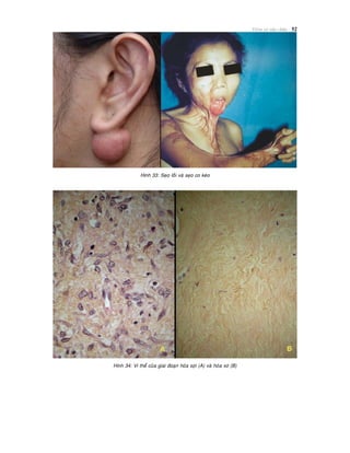 Vieâm vaø söûa chöõa 52
Hình 33: Seïo loài vaø seïo co keùo
Hình 34: Vi theå cuûa giai ñoaïn hoùa sôïi (A) vaø hoùa xô (B)
 