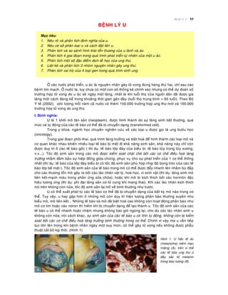 Beänh lyù U 55
BEÄNH LYÙ U
Muïc tieâu:
1. Neâu roõ vaø phaân tích ñònh nghóa cuûa u.
2. Neâu cô sôû phaân loaïi u vaø caùch ñaët teân u.
3. Phaân tích vaø so saùnh hình thaùi toån thöông cuûa u laønh vaø aùc.
4. Phaân tích 4 giai ñoaïn trong quaù trình phaùt trieån töï nhieân cuûa moät u aùc.
5. Phaân tích moät soá ñaëc ñieåm dòch teã hoïc cuûa ung thö.
6. Lieät keâ vaø phaân tích 3 nhoùm nguyeân nhaân gaây ung thö.
7. Phaân tích vai troø cuûa 4 loaïi gen trong quaù trình sinh ung.
ÔÛ caùc nöôùc phaùt trieån, u aùc laø nguyeân nhaân gaây töû vong ñuùng haøng thöù hai, chæ sau caùc
beänh tim maïch. ÔÛ nöôùc ta, tuy chöa coù moät con soá thoáng keâ chính xaùc nhöng coù theå döï ñoaùn soá
tröôøng hôïp töû vong do u aùc seõ ngaøy moät taêng, nhaát laø khi tuoåi thoï cuûa ngöôøi daân ñaõ ñöôïc gia
taêng moät caùch ñaùng keå trong khoaûng thôøi gian gaàn ñaây (tuoåi thoï trung bình > 65 tuoåi). Theo Boä
Y teá (2002), öôùc löôïng moãi naêm caû nöôùc coù theâm 150.000 tröôøng hôïp ung thö môùi vaø 100.000
tröôøng hôïp töû vong do ung thö.
I. Ñònh nghóa:
U laø 1 khoái moâ taân saûn (neoplasm), ñöôïc hình thaønh do söï taêng sinh baát thöôøng, quaù
möùc vaø töï ñoäng cuûa caùc teá baøo cô theå ñaõ bò chuyeån daïng (transformed cell).
Trong y khoa, ngaønh hoïc chuyeân nghieân cöùu veà caùc loaïi u ñöôïc goïi laø ung böôùu hoïc
(oncology).
Trong giai ñoaïn phoâi thai, quaù trình taêng tröôûng vaø bieät hoaù ñeå hình thaønh caùc loaïi moâ vaø
cô quan khaùc nhau khieán nhieàu loaïi teá baøo bò maát ñi khaû naêng sinh saûn, khaû naêng naøy chæ coøn
ñöôïc duy trì ôû caùc teá baøo goác ( thí duï: teá baøo lôùp ñaùy cuûa bieåu bì, teá baøo tuûy trong tuûy xöông,
v.v...). Toác ñoä sinh saûn trong caùc moâ ñöôïc kieåm soaùt chaët cheõ bôûi caùc cô cheá ñieàu hoaø taêng
tröôûng nhaèm ñaûm baûo söï hieäp ñoàng giöõa chuùng, phuïc vuï cho söï phaùt trieån cuûa 1 cô theå thoáng
nhaát (thí duï: teá baøo cuûa lôùp ñaùy bieåu bì coù toác ñoä sinh saûn phuø hôïp nhòp ñoä bong troùc cuûa caùc teá
baøo lôùp beà maët ). Toác ñoä sinh saûn cuûa teá baøo trong moâ coù theå ñöôïc ñaåy nhanh leân nhaèm buø ñaép
cho caùc thöông toån moâ gaây ra bôûi caùc taùc nhaân vaät lyù, hoaù hoïc, vi sinh vaät (thí duï: taêng sinh moâ
lieân keát-maïch maùu trong phaûn öùng söûa chöõa); hoaëc khi moâ bò kích thích bôûi caùc hormoân ñaëc
hieäu töông öùng (thí duï: phì ñaïi taêng saûn cô töû cung khi mang thai). Khi caùc taùc nhaân kích thích
noùi treân khoâng coøn nöõa, toác ñoä sinh saûn laïi trôû veà bình thöôøng nhö tröôùc.
U coù theå xuaát phaùt töø caùc teá baøo cô theå ñaõ bò chuyeån daïng cuûa baát kyø moâ naøo trong cô
theå. Tuy vaäy, u hay gaëp hôn ôû nhöõng moâ coøn duy trì hieän töôïng phaân baøo thöôøng xuyeân nhö
bieåu moâ, moâ lieân keát... Nhöõng teá baøo vaø moâ ñaõ bieät hoaù cao khoâng coøn hoaït ñoäng phaân baøo nhö
moâ cô tim hoaëc caùc nôron thì hieám khi bò chuyeån daïng ñeå taïo thaønh u. Toác ñoä sinh saûn cuûa caùc
teá baøo u coù theå nhanh hoaëc chaäm nhöng khoâng bao giôø ngöøng laïi, cho duø caùc taùc nhaân sinh u
khoâng coøn nöõa; noùi caùch khaùc, söï sinh saûn cuûa caùc teá baøo u coù tính töï ñoäng, khoâng coøn bò kieåm
soaùt bôûi caùc cô cheá ñieàu hoaø taêng tröôûng bình thöôøng trong cô theå. Chính vì vaäy maø u vaãn tieáp
tuïc lôùn leân trong khi beänh nhaân ngaøy moät suy moøn, coù theå gaây töû vong neáu khoâng ñöôïc phaãu
thuaät caét boû kòp thôøi. (Hình 1)
Hình 1: U haéc toá aùc
(melanoma) nieâm maïc
mieäng (A), treân vi theå
caùc teá baøo ung thö öù
ñaày saéc toá melanin
trong baøo töông (B)
 