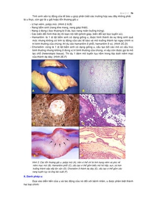 Beänh lyù U 56
Tính sinh saûn töï ñoäng cuûa teá baøo u giuùp phaân bieät caùc tröôøng hôïp sau ñaây khoâng phaûi
laø u thöïc, coøn goïi laø u giaû hoaëc toån thöông giaû u:
- U haït vieâm, polyùp muõi. (Hình 2 A,B)
- Nang baåm sinh (nang khe mang, nang giaùp thieät).
- Nang öù ñoïng ( boïc thöôïng bì ôû da, boïc nang noaõn buoàng tröùng).
- Caùc bieán ñoåi hình thaùi do roái loaïn noäi tieát (phình giaùp, bieán ñoåi sôïi boïc tuyeán vuù).
- Hamartoâm: laø 1 dò taät baåm sinh coù daïng gioáng u, ñöôïc hình thaønh do söï taêng sinh quaù
möùc nhöng khoâng coù tính töï ñoäng cuûa caùc teá baøo vaø moâ tröôûng thaønh taïi ngay chính vò
trí bình thöôøng cuûa chuùng; thí duï caùc hamartoâm ôû phoåi, hamartoâm ôû vuù. (Hình 2C,D)
- Choristoâm: cuõng laø 1 dò taät baåm sinh coù daïng gioáng u, caáu taïo bôûi caùc moâ coù caáu truùc
bình thöôøng nhöng khoâng ôû ñuùng vò trí bình thöôøng cuûa chuùng, vì vaäy coøn ñöôïc goïi laø moâ
laïc choã (heterotopic tissue). Thí duï 1 ñaùm moâ tuyeán tuïy naèm trong lôùp döôùi nieâm maïc
cuûa thaønh daï daøy. (Hình 2E,F)
Hình 2: Caùc toån thöông giaû u: polyùp muõi (A), treân vi theå chæ laø tình traïng vieâm vaø phuø neà
nieâm maïc muõi (B); Hamartoâm phoåi (C), caáu taïo vi theå goàm bieåu moâ hoâ haáp, suïn, cô trôn
tröôûng thaønh saép xeáp loän xoän (D); Choristoâm ôû thaønh daï daøy (E), caáu taïo vi theå goàm caùc
nang tuyeán tuïy vaø oáng baøi xuaát (F).
II. Danh phaùp u:
Döïa vaøo dieãn tieán cuûa u vaø taùc ñoäng cuûa noù ñoái vôùi beänh nhaân, u ñöôïc phaân bieät thaønh
hai loaïi chính:
 