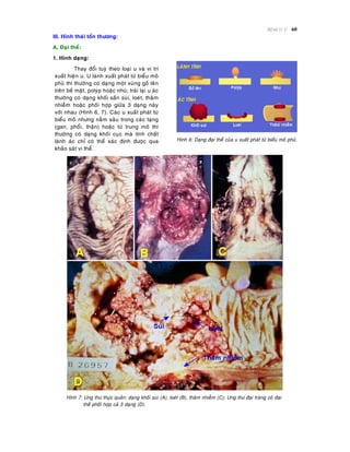 Beänh lyù U 60
III. Hình thaùi toån thöông:
A. Ñaïi theå:
1. Hình daïng:
Hình 6: Daïng ñaïi theå cuûa u xuaát phaùt töø bieåu moâ phuû.
Hình 7: Ung thö thöïc quaûn: daïng khoái suøi (A), loeùt (B), thaâm nhieãm (C); Ung thö ñaïi traøng coù ñaïi
theå phoái hôïp caû 3 daïng (D).
Thay ñoåi tuyø theo loaïi u vaø vò trí
xuaát hieän u. U laønh xuaát phaùt töø bieåu moâ
phuû thì thöôøng coù daïng moät vuøng goà leân
treân beà maët, polyùp hoaëc nhuù; traùi laïi u aùc
thöôøng coù daïng khoái saàn suøi, loeùt, thaâm
nhieãm hoaëc phoái hôïp giöõa 3 daïng naøy
vôùi nhau (Hình 6, 7). Caùc u xuaát phaùt töø
bieåu moâ nhöng naèm saâu trong caùc taïng
(gan, phoåi, thaän) hoaëc töø trung moâ thì
thöôøng coù daïng khoái cuïc maø tính chaát
laønh aùc chæ coù theå xaùc ñònh ñöôïc qua
khaûo saùt vi theå.
 