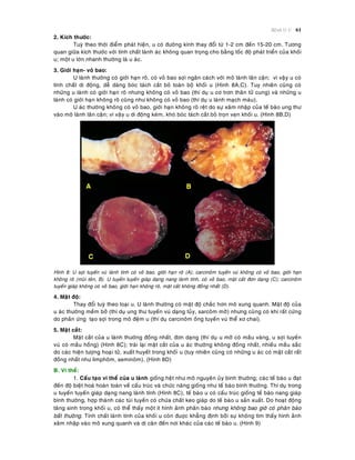 Beänh lyù U 61
2. Kích thöôùc:
Tuyø theo thôøi ñieåm phaùt hieän, u coù ñöôøng kính thay ñoåi töø 1-2 cm ñeán 15-20 cm. Töông
quan giöõa kích thöôùc vôùi tính chaát laønh aùc khoâng quan troïng cho baèng toác ñoä phaùt trieån cuûa khoái
u; moät u lôùn nhanh thöôøng laø u aùc.
3. Giôùi haïn- voû bao:
U laønh thöôøng coù giôùi haïn roõ, coù voû bao sôïi ngaên caùch vôùi moâ laønh laân caän; vì vaäy u coù
tính chaát di ñoäng, deã daøng boùc taùch caét boû toaøn boä khoái u (Hình 8A,C). Tuy nhieân cuõng coù
nhöõng u laønh coù giôùi haïn roõ nhöng khoâng coù voû bao (thí duï u cô trôn thaân töû cung) vaø nhöõng u
laønh coù giôùi haïn khoâng roõ cuõng nhö khoâng coù voû bao (thí duï u laønh maïch maùu).
U aùc thöôøng khoâng coù voû bao, giôùi haïn khoâng roõ reät do söï xaâm nhaäp cuûa teá baøo ung thö
vaøo moâ laønh laân caän; vì vaäy u di ñoäng keùm, khoù boùc taùch caét boû troïn veïn khoái u. (Hình 8B,D)
Hình 8: U sôïi tuyeán vuù laønh tính coù voû bao, gIôùi haïn roõ (A); carcinoâm tuyeán vuù khoâng coù voû bao, giôùi haïn
khoâng roõ (muõi teân, B). U tuyeán tuyeán giaùp daïng nang laønh tính, coù voû bao, maët caét ñôn daïng (C); carcinoâm
tuyeán giaùp khoâng coù voû bao, giôùi haïn khoâng roõ, maët caét khoâng ñoàng nhaát (D).
4. Maät ñoä:
Thay ñoåi tuyø theo loaïi u. U laønh thöôøng coù maät ñoä chaéc hôn moâ xung quanh. Maät ñoä cuûa
u aùc thöôøng meàm bôû (thí duï ung thö tuyeán vuù daïng tuûy, sarcoâm môõ) nhöng cuõng coù khi raát cöùng
do phaûn öùng taïo sôïi trong moâ ñeäm u (thí duï carcinoâm oáng tuyeán vuù theå xô chai).
5. Maët caét:
Maët caét cuûa u laønh thöôøng ñoàng nhaát, ñôn daïng (thí duï u môõ coù maàu vaøng, u sôïi tuyeán
vuù coù maàu hoàng) (Hình 8C); traùi laïi maët caét cuûa u aùc thöôøng khoâng ñoàng nhaát, nhieàu maàu saéc
do caùc hieän töôïng hoaïi töû, xuaát huyeát trong khoái u (tuy nhieân cuõng coù nhöõng u aùc coù maët caét raát
ñoàng nhaát nhö limphoâm, seminoâm). (Hình 8D)
B. Vi theå:
1. Caáu taïo vi theå cuûa u laønh gioáng heät nhö moâ nguyeân uûy bình thöôøng; caùc teá baøo u ñaït
ñeán ñoä bieät hoaù hoaøn toaøn veà caáu truùc vaø chöùc naêng gioáng nhö teá baøo bình thöôøng. Thí duï trong
u tuyeán tuyeán giaùp daïng nang laønh tính (Hình 8C), teá baøo u coù caáu truùc gioáng teá baøo nang giaùp
bình thöôøng, hôïp thaønh caùc tuùi tuyeán coù chöùa chaát keo giaùp do teá baøo u saûn xuaát. Do hoaït ñoäng
taêng sinh trong khoái u, coù theå thaáy moät ít hình aûnh phaân baøo nhöng khoâng bao giôø coù phaân baøo
baát thöôøng. Tính chaát laønh tính cuûa khoái u coøn ñuôïc khaúng ñònh bôûi söï khoâng tìm thaáy hình aûnh
xaâm nhaäp vaøo moâ xung quanh vaø di caên ñeán nôi khaùc cuûa caùc teá baøo u. (Hình 9)
 