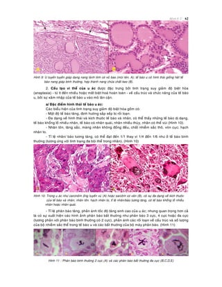 Beänh lyù U 62
Hình 9: U tuyeán tuyeán giaùp daïng nang laønh tính coù voû bao (muõi teân, A); teá baøo u coù hình thaùi gioáng heät teá
baøo nang giaùp bình thöôøng, hôïp thaønh nang chöùa chaát keo (B).
2. Caáu taïo vi theå cuûa u aùc ñöôïc ñaëc tröng bôûi tình traïng suy giaûm ñoä bieät hoùa
(anaplasia) - töø ít ñeán nhieàu hoaëc maát bieät hoaù hoaøn toaøn - veà caáu truùc vaø chöùc naêng cuûa teá baøo
u, bôûi söï xaâm nhaäp cuûa teá baøo u vaøo moâ laân caän.
a/ Ñaëc ñieåm hình thaùi teá baøo u aùc:
Caùc bieåu hieän cuûa tình traïng suy giaûm ñoä bieät hoùa goàm coù:
- Maät ñoä teá baøo taêng, ñònh höôùng saép xeáp bò roái loaïn.
- Ña daïng veà hình thaùi vaø kích thöôùc teá baøo vaø nhaân, coù theå thaáy nhöõng teá baøo dò daïng,
teá baøo khoång loà nhieàu nhaân, teá baøo coù nhaân quaùi, nhaân nhieàu thuøy, nhaân coù theå vuøi (Hình 10).
- Nhaân lôùn, taêng saéc, maøng nhaân khoâng ñoàng ñeàu, chaát nhieãm saéc thoâ, voùn cuïc; haïch
nhaân to.
- Tæ leä nhaân/ baøo töông taêng, coù theå ñaït ñeán 1/1 thay vì 1/4 ñeán 1/6 nhö ôû teá baøo bình
thöôøng (töông öùng vôùi tình traïng ña boäi theå trong nhaân). (Hình 10)
Hình 10: Trong u aùc nhö carcinoâm oáng tuyeán vuù (A) hoaëc sarcoâm cô vaân (B), coù söï ña daïng veà kích thöôùc
cuûa teá baøo vaø nhaân; nhaân lôùn. haïch nhaân to, tæ leä nhaân/baøo töông taêng, coù teá baøo khoång loà nhieàu
nhaân hoaëc nhaân quaùi.
- Tæ leä phaân baøo taêng, phaûn aùnh toác ñoä taêng sinh cao cuûa u aùc; nhöng quan troïng hôn caû
laø coù söï xuaát hieän caùc hình aûnh phaân baøo baát thöôøng nhö phaân baøo 3 cöïc, 4 cöïc hoaëc ña cöïc
(töông phaûn vôùi phaân baøo bình thöôøng coù 2 cöïc), phaûn aùnh caùc roái loaïn veà caáu truùc vaø soá löôïng
cuûa boä nhieãm saéc theå trong teá baøo u vaø caùc baát thöôøng cuûa boä maùy phaân baøo. (Hình 11)
Hình 11 : Phaân baøo bình thöôøng 2 cöïc (A) vaø caùc phaân baøo baát thöôøng ña cöïc (B,C,D,E)
 