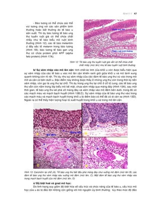 Beänh lyù U 63
- Baøo töông coù theå chöùa caùc theå
vuøi töông öùng vôùi caùc saûn phaåm bình
thöôøng hoaëc baát thöôøng do teá baøo u
saûn xuaát. Thí duï baøo töông teá baøo ung
thö tuyeán ruoät giaø coù theå chöùa chaát
nhaày nhö teá baøo bieåu moâ ruoät bình
thöôøng (Hình 12); caùc teá baøo melanoâm
öù ñaày saéc toá melanin trong baøo töông
(Hình 1B); baøo töông teá baøo gan ung
thö coù chöùa protein phoâi AFP (alpha
feto protein) (Hình 17A).
Hình 12: Teá baøo ung thö tuyeán ruoät giaø vaãn coù theå chöùa chaát
chaát nhaày (muõi teân) nhö teá baøo tuyeán ruoät bình thöôøng.
b/ Söï xaâm nhaäp vaøo moâ laân caän: tính chaát aùc tính cuûa khoái u coøn ñöôïc bieåu hieän qua
söï xaâm nhaäp cuûa caùc teá baøo u vaøo moâ laân caän khieán ranh giôùi giöõa khoái u vaø moâ laønh xung
quanh khoâng coøn roõ reät. Thí duï nhö söï xaâm nhaäp cuûa caùc ñaùm teá baøo ung thö vuù vaøo trong moâ
môõ vaø caân cô beân döôùi u. Ñaëc ñieåm naøy khoâng ñöôïc thaáy ôû nhöõng ung thö coøn trong thôøi kyø tieàn
xaâm nhaäp, coøn goïi laø ung thö taïi choã. Thí duï trong ung thö taïi choã ôû coå töû cung, caùc teá baøo ung
thö vaãn coøn naèm trong lôùp bieåu moâ beà maët, chöa xaâm nhaäp qua maøng ñaùy (Hình 13A), sau moät
thôøi gian, teá baøo ung thö seõ phaù vôõ maøng ñaùy vaø xaâm nhaäp vaøo moâ ñeäm beân döôùi, trong ñoù coù
caùc maïch maùu vaø maïch baïch huyeát (Hình 13B,C). Söï xaâm nhaäp cuûa teá baøo ung thö vaøo trong
caùc maïch maùu vaø maïch baïch huyeát trong khoái u laø ñieàm baùo coù theå ñaõ coù di caên xa (Hình 13D).
Ngoaøi ra coù theå thaáy hieän töôïng hoaïi töû xuaát huyeát trong khoái u vaø trong moâ laân caän.
Hình 13: Carcinoâm taïi choã (A); Teá baøo ung thö baét ñaàu phaù maøng ñaùy chui xuoáng moâ ñeäm (muõi teân B); caùc
ñaùm teá baøo ung thö xaâm nhaäp saâu xuoáng moâ ñeäm (muõi teân, C); Moät ñaùm teá baøo ung thö xaâm nhaäp vaøo
trong maïch baïch huyeát cuûa moâ ñeäm (muõi teân, D)
c/ Ñoä bieät hoaù vaø grad moâ hoïc:
Do tình traïng suy giaûm ñoä bieät hoùa veà caáu truùc vaø chöùc naêng cuûa teá baøo u, caáu truùc moâ
hoïc cuûa u aùc bò ñaûo loän khoâng coøn gioáng vôùi moâ nguyeân uûy bình thöôøng; tuøy theo möùc ñoä ñaûo
 
