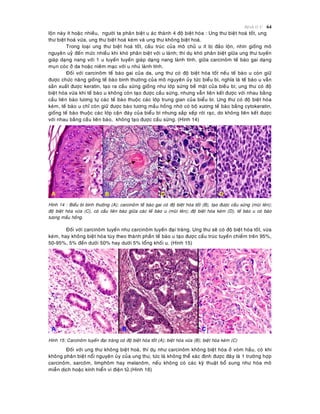Beänh lyù U 64
loän naøy ít hoaëc nhieàu, ngöôøi ta phaân bieät u aùc thaønh 4 ñoä bieät hoùa : Ung thö bieät hoaù toát, ung
thö bieät hoaù vöøa, ung thö bieät hoaù keùm vaø ung thö khoâng bieät hoaù.
Trong loaïi ung thö bieät hoaù toát, caáu truùc cuûa moâ chuû u ít bò ñaûo loän, nhìn gioáng moâ
nguyeân uyû ñeán möùc nhieàu khi khoù phaân bieät vôùi u laønh; thí duï khoù phaân bieät giöõa ung thö tuyeán
giaùp daïng nang vôùi 1 u tuyeán tuyeán giaùp daïng nang laønh tính, giöõa carcinoâm teá baøo gai daïng
muïn coùc ôû da hoaëc nieâm maïc vôùi u nhuù laønh tính.
Ñoái vôùi carcinoâm teá baøo gai cuûa da, ung thö coù ñoä bieät hoùa toát neáu teá baøo u coøn giöõ
ñöôïc chöùc naêng gioáng teá baøo bình thöôøng cuûa moâ nguyeân uûy töùc bieåu bì, nghóa laø teá baøo u vaãn
saûn xuaát ñöôïc keratin, taïo ra caàu söøng gioáng nhö lôùp söøng beà maët cuûa bieàu bì; ung thö coù ñoä
bieät hoùa vöøa khi teá baøo u khoâng coøn taïo ñöôïc caàu söøng, nhöng vaãn lieân keát ñöôïc vôùi nhau baèng
caàu lieân baøo töông töï caùc teá baøo thuoäc caùc lôùp trung gian cuûa bieåu bì. Ung thö coù ñoä bieät hoùa
keùm, teá baøo u chæ coøn giöõ ñöôïc baøo töông maàu hoàng nhôø coù boä xöông teá baøo baèng cytokeratin,
gioáng teá baøo thuoäc caùc lôùp caän ñaùy cuûa bieåu bì nhöng saép xeáp rôøi raïc, do khoâng lieân keát ñöôïc
vôùi nhau baèng caàu lieân baøo, khoâng taïo ñöôïc caàu söøng. (Hình 14)
Hình 14 : Bieåu bì bình thöôøng (A); carcinoâm teá baøo gai coù ñoä bieät hoùa toát (B), taïo ñöôïc caàu söøng (muõi teân);
ñoä bieät hoùa vöøa (C), coù caàu lieân baøo giöõa caùc teá baøo u (muõi teân); ñoä bieät hoùa keùm (D), teá baøo u coù baøo
töong maàu hoàng.
Ñoái vôùi carcinoâm tuyeán nhö carcinoâm tuyeán ñaïi traøng. Ung thö seõ coù ñoä bieät hoùa toát, vöøa
keùm, hay khoâng bieät hoùa tuøy theo thaønh phaàn teá baøo u taïo ñöôïc caáu truùc tuyeán chieám treân 95%,
50-95%, 5% ñeán döôùi 50% hay döôùi 5% toång khoái u. (Hình 15)
Hình 15: Carcinoâm tuyeán ñaïi traøng coù ñoä bieät hoùa toát (A); bieät hoùa vöøa (B); bieät hoùa keùm (C)
Ñoái vôùi ung thö khoâng bieät hoaù, thí duï nhö carcinoâm khoâng bieät hoùa ôû voøm haàu, coù khi
khoâng phaân bieät noåi nguyeân uûy cuûa ung thö, töùc laø khoâng theå xaùc ñònh ñöôïc ñaây laø 1 tröôøng hôïp
carcinoâm, sarcoâm, limphoâm hay melanoâm, neáu khoâng coù caùc kyõ thuaät boå sung nhö hoùa moâ
mieãn dòch hoaëc kính hieån vi ñieän töû.(Hình 16)
 