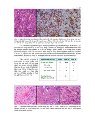 Beänh lyù U 65
Hình 16: Carcinoâm khoâng bieät hoùa voøm haàu: nhuoäm HE thaáy caùc ñaùm teá baøo nhaân lôùn dò daïng (muõi teân),
khoâng phaân bieät chaéc chaén laø carcinoâm hay limphoâm. Nhuoäm hoùa moâ mieãn dòch thaáy caùc ñaùm teá baøo naøy
aâm tính vôùi LCA nhöng döông tính vôùi cytokeratin; chöùng toû ñaây laø moät carcinoâm.
Caùc u aùc tính ñöôïc xeáp loaïi grad moâ hoïc (Histologic grade) ñeå ñaùnh giaù ñoä aùc tính, u coù
grad moâ hoïc caøng cao thì ñoä aùc tính caøng taêng. Coù nhieàu heä thoáng grad moâ hoïc khaùc nhau nhö
heä thoáng 4 grad moâ hoïc (grad I, II, II, IV), heä thoáng 3 grad ( grad I, II, III) vaø heä thoáng 2 grad
(grad thaáp vaø grad cao). Caùc tieâu chuaån ñöôïc duøng ñeå phaân grad cuõng khaùc nhau tuøy töøng loaïi
u, vò trí u vaø tuøy theo taùc giaû, thöôøng bao goàm caùc tieâu chuaån nhö maät ñoä teá baøo trong u, ñoä bieät
hoùa teá baøo u, möùc ñoä ña daïng vaø dò daïng teá baøo, chæ soá phaân baøo, möùc ñoä hoaïi töû trong u…
Treân thöïc teá, heä thoáng 3
grad ñöôïc söû duïng nhieàu nhaát
trong xeáp loaïi grad moâ hoïc, döïa
vaøo 2 tieâu chuaån chính laø ñoä bieät
hoùa cuûa teá baøo u vaø chæ soá phaân
baøo trong khoái u; thí duï nhö caùch
xeáp loaïi grad moâ hoïc cuûa
carcinoâm teá baøo gai cuûa da theo
taùc giaû Warren. (Hình 17)
Hình 17: Carcinoâm teá baøo gai Grad I, coù caàu söøng (muõi teân, A); Grad II khoâng coù caàu söøng nhöng coù caàu
lieân baøo (muõi teân, B); Grad III vôùi teá baøo u coù baøo töông aùi toan, nhieàu phaân baøo (muõi teân, C), nhöng khoâng
coù caàu söøng vaø caàu lieân baøo.
 