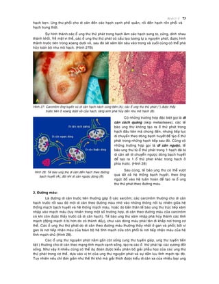 Beänh lyù U 73
haïch beïn. Ung thö phoåi cho di caên ñeán caùc haïch caïnh pheá quaûn, roài ñeán haïch roán phoåi vaø
haïch trung thaát.
Söï hình thaønh caùc oå ung thö thöù phaùt trong haïch laøm caùc haïch söng to, cöùng, dính nhau
thaønh khoái. Veà maët vi theå, caùc oå ung thö thöù phaùt coù caáu taïo töông töï u nguyeân phaùt, ñöôïc hình
thaønh tröôùc tieân trong xoang döôùi voû, sau ñoù seõ xaâm laán saâu vaøo trong vaø cuoái cuøng coù theå phaù
huûy toaøn boä nhu moâ haïch. (Hinh 27B)
Hình 27: Carcinoâm oáng tuyeán vuù di caên haïch naùch cuøng beân (A); caùc oå ung thö thöù phaùt (*) ñöôïc thaáy
tröôùc tieân ôû xoang döôùi voû cuûa haïch, taêng sinh phaù huûy daàn nhu moâ haïch (B).
Hình 28: Teá baøo ung thö di caên ñeán haïch theo ñöôøng
baïch huyeát (A); ñoâi khi di caên ngöôïc doøng (B).
Coù nhöõng tröôøng hôïp ñaëc bieät goïi laø di
caên caùch quaõng (skip metastases), caùc teá
baøo ung thö khoâng taïo ra oå thöù phaùt trong
haïch ñaàu tieân maø chuùng ñeán, nhöng tieáp tuïc
di chuyeån theo doøng baïch huyeát ñeå taïo oå thöù
phaùt trong nhöõng haïch tieáp sau ñoù. Cuõng coù
nhöõng tröôøng hôïp goïi laø di caên ngöôïc, teá
baøo ung thö töø oå thöù phaùt trong 1 haïch ñaõ bò
di caên seõ di chuyeån ngöôïc doøng baïch huyeát
ñeå taïo ra 1 oå thöù phaùt khaùc trong haïch ôû
phía tröôùc. (Hình 28)
Sau cuøng, teá baøo ung thö coù theå vöôït
qua taát caû heä thoáng baïch huyeát, theo oáng
ngöïc ñoå vaøo heä tuaàn hoaøn ñeå taïo ra oå ung
thö thöù phaùt theo ñöôøng maùu.
2. Ñöôøng maùu:
Laø ñöôøng di caên tröôùc tieân thöôøng gaëp ôû caùc sarcoâm; caùc carcinoâm thöôøng cho di caên
haïch tröôùc roài sau ñoù môùi di caên theo ñöôøng maùu nhôø vaøo nhöõng thoâng noái töï nhieân giöõa heä
thoáng maïch baïch huyeát vaø heä thoáng maïch maùu, hoaëc do baûn thaân teá baøo ung thö tröïc tieáp xaâm
nhaäp vaøo maïch maùu (tuy nhieân trong moät soá tröôøng hôïp, di caên theo ñöôøng maùu cuûa carcinoâm
coù khi coøn ñöôïc thaáy tröôùc caû di caên haïch). Teá baøo ung thö xaâm nhaäp phaù huûy thaønh caùc tónh
maïch (ñoäng maïch ít bò hôn do coù thaønh daày), chui vaøo doøng maùu phaùt taùn ñi khaép nôi trong cô
theå. Caùc oå ung thö thöù phaùt do di caên theo ñöôøng maùu thöôøng thaáy nhaát ôû gan vaø phoåi; bôûi vì
gan laø nôi tieáp nhaän maùu cuûa toaøn boä heä tónh maïch cöûa coøn phoåi laø nôi tieáp nhaän maùu cuûa heä
tónh maïch chuû (Hình 28).
Caùc oå ung thö nguyeân phaùt naèm gaàn coät soáng (ung thö tuyeán giaùp, ung thö tuyeán tieàn
lieät ) thöôøng cho di caên theo maïng tónh maïch caïnh soáng, taïo ra caùc oå thöù phaùt taïi caùc xöông ñoát
soáng. Nhö vaäy ít nhieàu cuõng coù theå döï ñoaùn ñöôïc kieåu phaân boá giaûi phaãu hoïc cuûa caùc ung thö
thöù phaùt trong cô theå, döïa vaøo vò trí cuûa ung thö nguyeân phaùt vaø söï daãn löu tónh maïch taïi ñoù.
Tuy nhieân neáu chæ ñôn giaûn nhö theá thì khoù maø giaûi thích ñöôïc kieåu di caên xa cuûa nhieàu loaïi ung
 