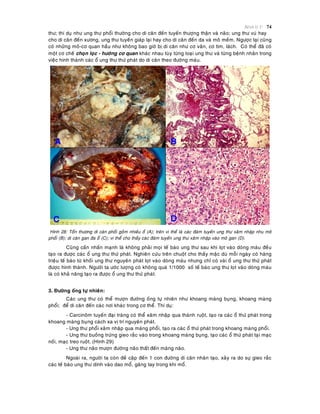 Beänh lyù U 74
thö; thí duï nhö ung thö phoåi thöôøng cho di caên ñeán tuyeán thöôïng thaän vaø naõo; ung thö vuù hay
cho di caên ñeán xöông, ung thö tuyeán giaùp laïi hay cho di caên ñeán da vaø moâ meàm. Ngöôïc laïi cuõng
coù nhöõng moâ-cô quan haàu nhö khoâng bao giôø bò di caên nhö cô vaân, cô tim, laùch. Coù theå ñaõ coù
moät cô cheá choïn loïc - höôùng cô quan khaùc nhau tuøy töøng loaïi ung thö vaø töøng beänh nhaân trong
vieäc hình thaønh caùc oå ung thö thöù phaùt do di caên theo ñöôøng maùu.
Hình 28: Toån thöông di caên phoåi goàm nhieàu oå (A); treân vi theå laø caùc ñaùm tuyeán ung thö xaâm nhaäp nhu moâ
phoåi (B); di caên gan ña oå (C); vi theå cho thaáy caùc ñaùm tuyeán ung thö xaâm nhaäp vaøo moâ gan (D).
Cuõng caàn nhaán maïnh laø khoâng phaûi moïi teá baøo ung thö sau khi loït vaøo doøng maùu ñeàu
taïo ra ñöôïc caùc oå ung thö thöù phaùt. Nghieân cöùu treân chuoät cho thaáy maëc duø moãi ngaøy coù haøng
trieäu teá baøo töø khoái ung thö nguyeân phaùt loït vaøo doøng maùu nhöng chæ coù vaøi oå ung thö thöù phaùt
ñöôïc hình thaønh. Ngöôøi ta öôùc löôïng coù khoâng quaù 1/1000 soá teá baøo ung thö loït vaøo doøng maùu
laø coù khaû naêng taïo ra ñöôïc oå ung thö thöù phaùt.
3. Ñöôøng oáng töï nhieân:
Caùc ung thö coù theå möôïn ñöôøng oáng töï nhieân nhö khoang maøng buïng, khoang maøng
phoåi; ñeå di caên ñeán caùc nôi khaùc trong cô theå. Thí duï:
- Carcinoâm tuyeán ñaïi traøng coù theå xaâm nhaäp qua thaønh ruoät, taïo ra caùc oå thöù phaùt trong
khoang maøng buïng caùch xa vò trí nguyeân phaùt.
- Ung thö phoåi xaâm nhaäp qua maøng phoåi, taïo ra caùc oå thöù phaùt trong khoang maøng phoåi.
- Ung thö buoàng tröùng gieo raéc vaøo trong khoang maøng buïng, taïo caùc oå thöù phaùt taïi maïc
noái, maïc treo ruoät. (Hình 29)
- Ung thö naõo möôïn ñöôøng naõo thaát ñeán maøng naõo.
Ngoaøi ra, ngöôøi ta coøn ñeà caäp ñeán 1 con ñöôøng di caên nhaân taïo, xaûy ra do söï gieo raéc
caùc teá baøo ung thö dính vaøo dao moå, gaêng tay trong khi moå.
 