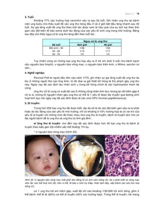 Beänh lyù U 78
3. Tuoåi:
Khoaûng 77% caùc tröôøng hôïp carcinoâm xaûy ra sau 55 tuoåi. Ghi nhaän ung thö taïi beänh
vieän ung böôùu cho thaáy xuaát ñoä caùc ung thö haøng ñaàu ôû caû 2 giôùi baét ñaàu taêng nhanh sau 40
tuoåi. Söï gia taêng xuaát ñoä ung thö theo tuoåi taùc ñöôïc xem laø haäu quaû cuûa söï tích luyõ theo thôøi
gian caùc ñoät bieán teá baøo soma döôùi taùc ñoäng cuûa caùc yeáu toá sinh ung trong moâi tröôøng. Baûng
sau ñaây cho thaáy nguy cô bò ung thö taêng daàn theo tuoåi taùc.
Nguy cô bò ung thö
Ñoä tuoåi Nam giôùi Nöõ giôùi
Môùi sinh - 39 1/58 1/52
40 - 59 1/13 1/11
60 - 79 1/3 1/4
Tuy nhieân cuõng coù nhöõng loaïi ung thö hay xaûy ra ôû treû em döôùi 5 tuoåi nhö beänh baïch
caàu nguyeân baøo limphoâ, u nguyeân baøo voõng maïc, u nguyeân baøo thaàn kinh, u Wilms, sarcoâm cô
vaân...
4. Ngheà nghieäp:
Percival Pott laø ngöôøi ñaàu tieân vaøo naêm 1775, ghi nhaän söï gia taêng xuaát ñoä ung thö da
bìu ôû nhöõng ngöôøi thôï caïo oáng khoùi, töø ñoù ñöa ra giaû thieát boà hoùng laø thuû phaïm gaây ung thö
naøy. Ngaøy nay ñaõ xaùc ñònh taùc nhaân sinh u trong boà hoùng chính laø caùc hydrocarbon thôm ña
voøng.
Ung thö coå töû cung coù xuaát ñoä cao ôû nhöõng coâng nhaân tình duïc nhöng laïi raát hieám gaëp ôû
nöõ tu só, chöùng toû nguyeân nhaân gaây ung thö coù theå laø 1 yeáu toá ñöôïc laây truyeàn qua ñöôøng sinh
hoaït tình duïc maø ngaøy nay ñaõ xaùc ñònh ñöôïc laø caùc viruùt HPV (human papillomavirus).
5. Di truyeàn:
Trong hôn 200 loaïi ung thö ñaõ ñöôïc bieát, ñaïi ña soá laø do caùc ñoät bieán gen xaûy ra töï phaùt
hoaëc do taùc ñoäng cuûa caùc yeáu toá moâi tröôøng; chæ coù khoaûng 5-10% tröôøng hôïp laø coù vai troø cuûa
yeáu toá di truyeàn vôùi nhöõng möùc ñoä khaùc nhau nhö ung thö di truyeàn, beänh di truyeàn laøm cho cô
ñòa ngöôøi beänh deã bò ung thö vaø ung thö coù tính gia ñình.
a/ Ung thö di truyeàn: cho ñeán nay ñaõ xaùc ñònh ñöôïc hôn 30 loaïi ung thö laø beänh di
truyeàn theo kieåu gen troäi-nhieãm saéc theå thöôøng. Thí duï:
* U nguyeân baøo voõng maïc (Hình 33):
Hình 33: U nguyeân baøo voõng maïc maét phaûi laøm ñoàng töû coù aùnh xaùm traéng (A); do u phaùt trieån töø voõng maïc
xaâm laán vaøo theå thuyû tinh (B); treân vi theå, teá baøo u hình truï thaáp, nhaân leäch ñaùy, xeáp thaønh caùc caáu truùc hoa
hoàng (C).
Laø 1 ung thö treû em hieám gaëp, xuaát ñoä chæ vaøo khoaûng 1/30.000 treû sinh soáng, goàm 2
theå beänh: theå leû teû (60%) vaø theå di truyeàn (40% caùc tröôøng hôïp). Trong theå di truyeàn, treû mang
 