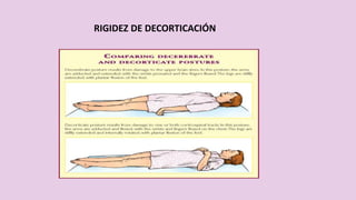 RIGIDEZ DE DECORTICACIÓN
 