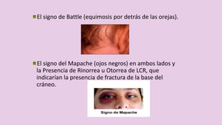 El signo de Battle (equimosis por detrás de las orejas).
El signo del Mapache (ojos negros) en ambos lados y
la Presencia de Rinorrea u Otorrea de LCR, que
indicarían la presencia de fractura de la base del
cráneo.
 