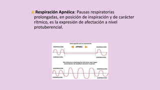 Respiración Apnéica: Pausas respiratorias
prolongadas, en posición de inspiración y de carácter
rítmico, es la expresión de afectación a nivel
protuberencial.
 