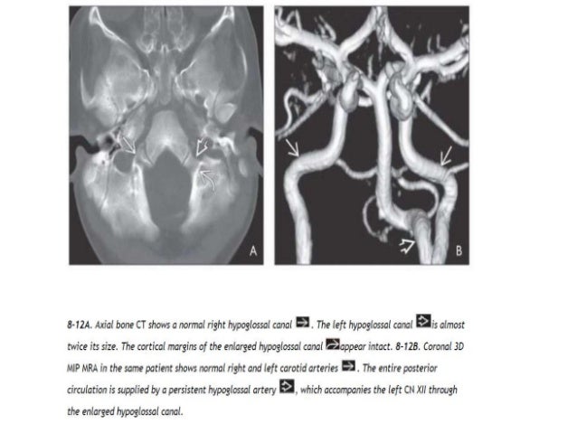 Vascular brain anatomy for Radiology by Dr Soumitra Halder