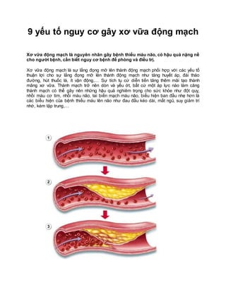 9 yếu tố nguy cơ gây xơ vữa động mạch
Xơ vữa động mạch là nguyên nhân gây bệnh thiếu máu não, có hậu quả nặng nề
cho người bệnh, cần biết nguy cơ bệnh để phòng và điều trị.
Xơ vữa động mạch là sự lắng đọng mỡ lên thành động mạch phối hợp với các yếu tố
thuận lợi cho sự lắng đọng mỡ lên thành động mạch như tăng huyết áp, đái tháo
đường, hút thuốc lá, ít vận động,… Sự tích tụ cứ diễn tiến tăng thêm mãi tạo thành
mãng xơ vữa. Thành mạch trở nên dòn và yếu ớt, bất cứ một áp lực nào làm căng
thành mạch có thể gây nên những hậu quả nghiêm trọng cho sức khỏe như đột quỵ,
nhồi máu cơ tim, nhồi máu não, tai biến mạch máu não, biểu hiện ban đầu nhẹ hơn là
các biểu hiện của bệnh thiếu máu lên não như đau đầu kéo dài, mất ngủ, suy giảm trí
nhớ, kém tập trung,…
 