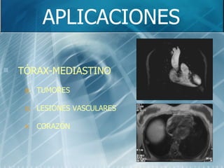 APLICACIONES TÓRAX-MEDIASTINO TUMORES LESIONES VASCULARES CORAZÓN 