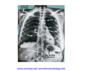 home.comcast.net/~wnor/thoraxradiology.htm 