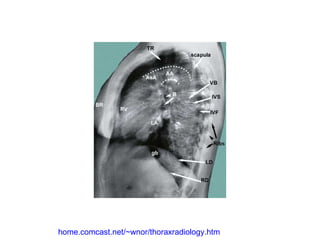 home.comcast.net/~wnor/thoraxradiology.htm 