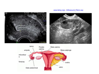 www.lahey.org/.../Ultrasound_Pelvic.asp istmo ampola Porção uterina infundíbulo fimbrias Ostio abdominal utero ovário Meso-salpinge Óstio uterino 