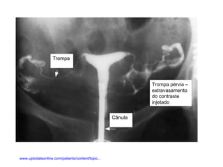 Trompa Trompa pérvia – extravasamento do contraste injetado Cânula www.uptodateonline.com/patients/content/topic... 